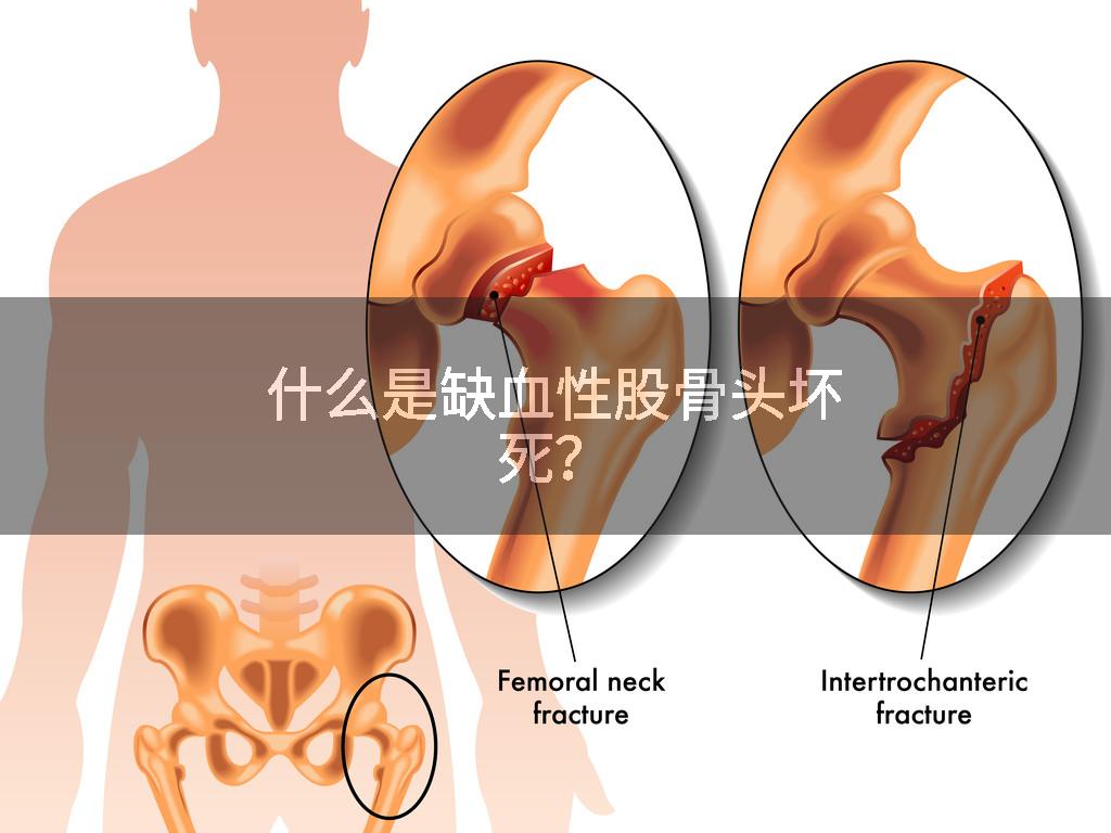 什么是缺血性股骨头坏死？