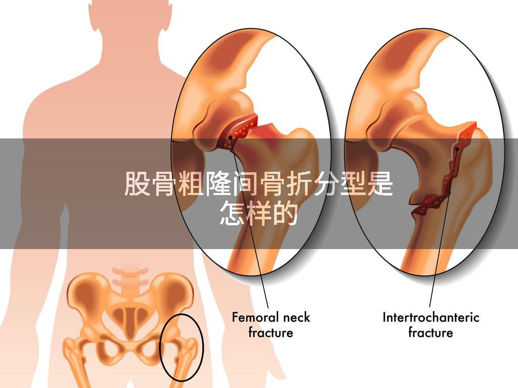 股骨粗隆间骨折分型是怎样的