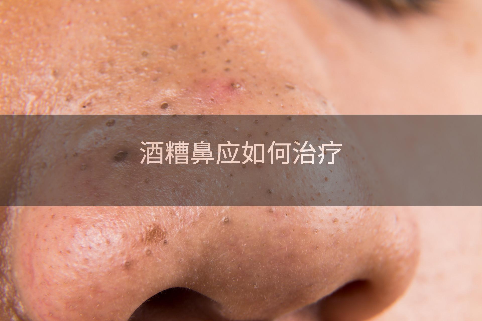 酒糟鼻应如何治疗