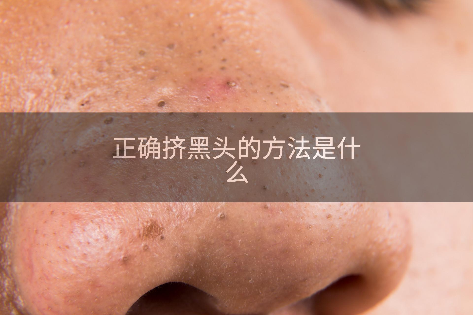 正确挤黑头的方法是什么