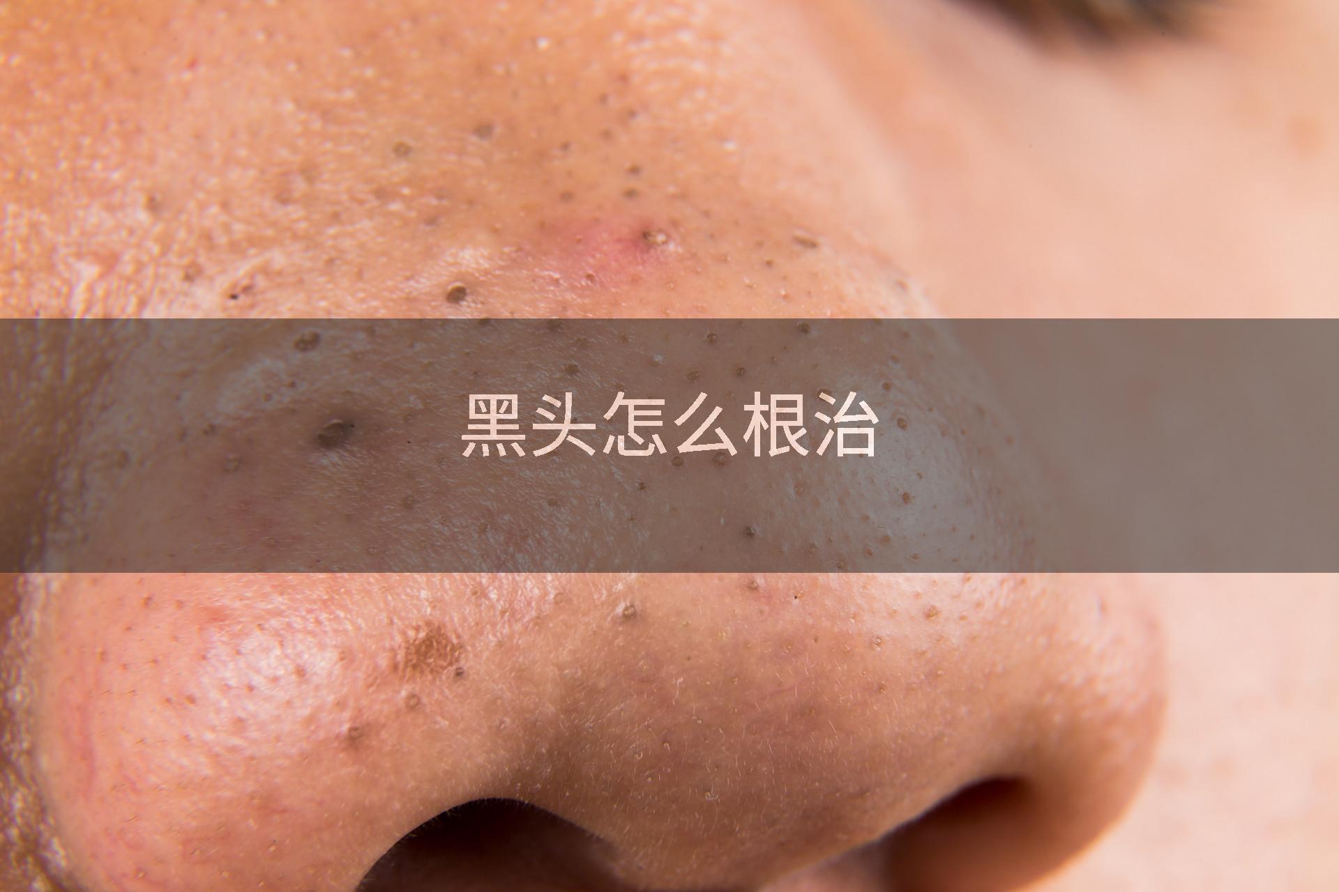 黑头怎么根治
