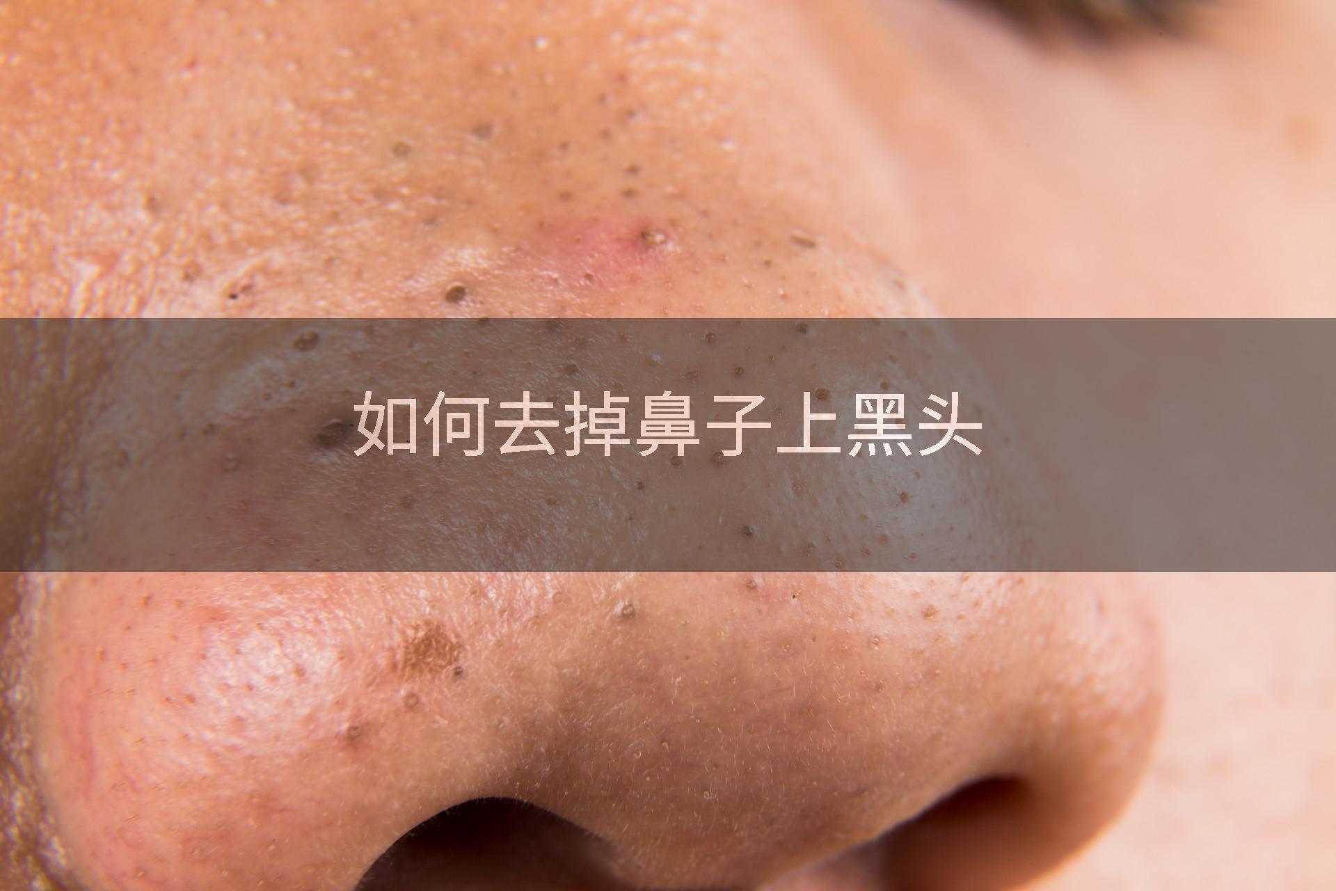 如何去掉鼻子上黑头