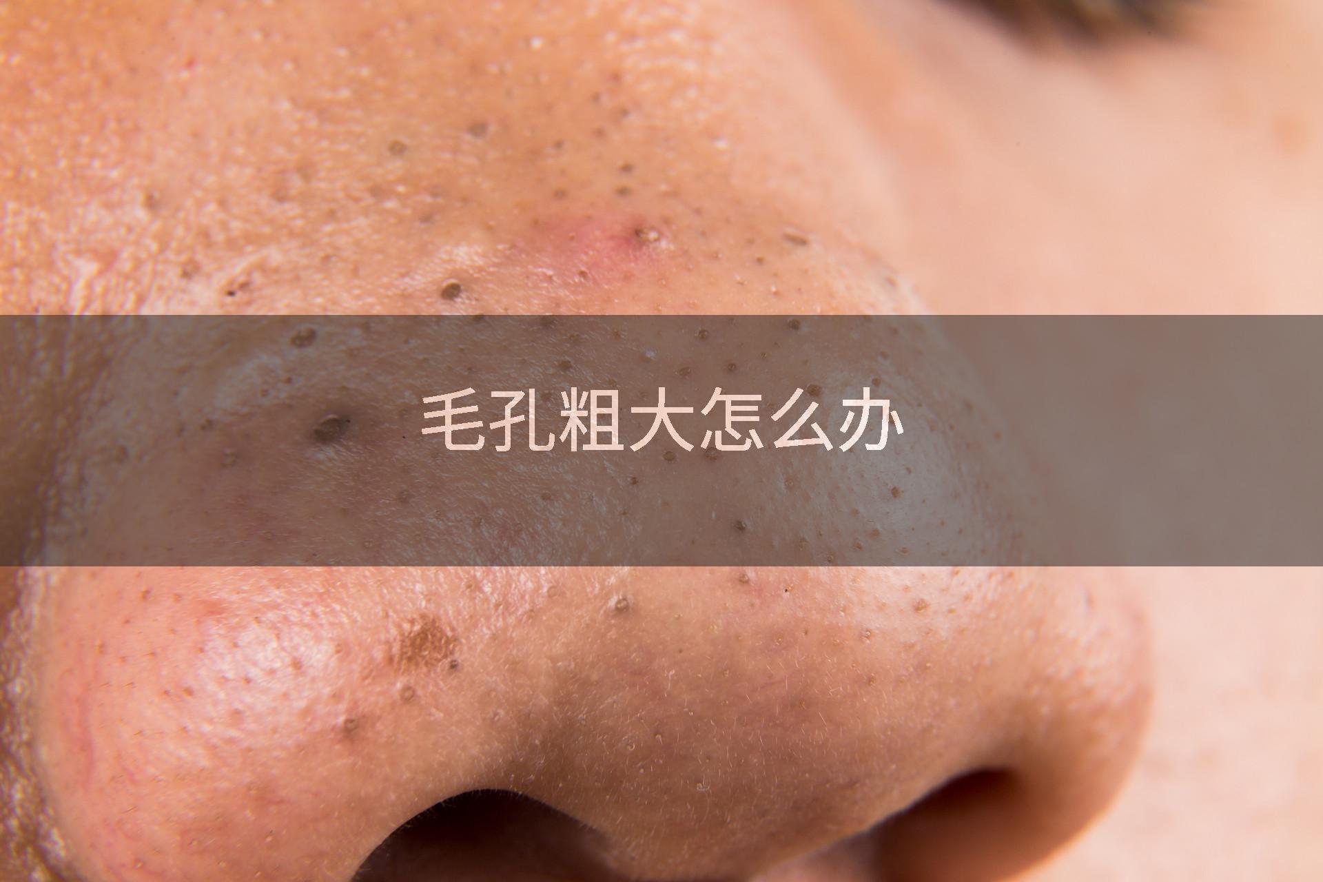 毛孔粗大怎么办