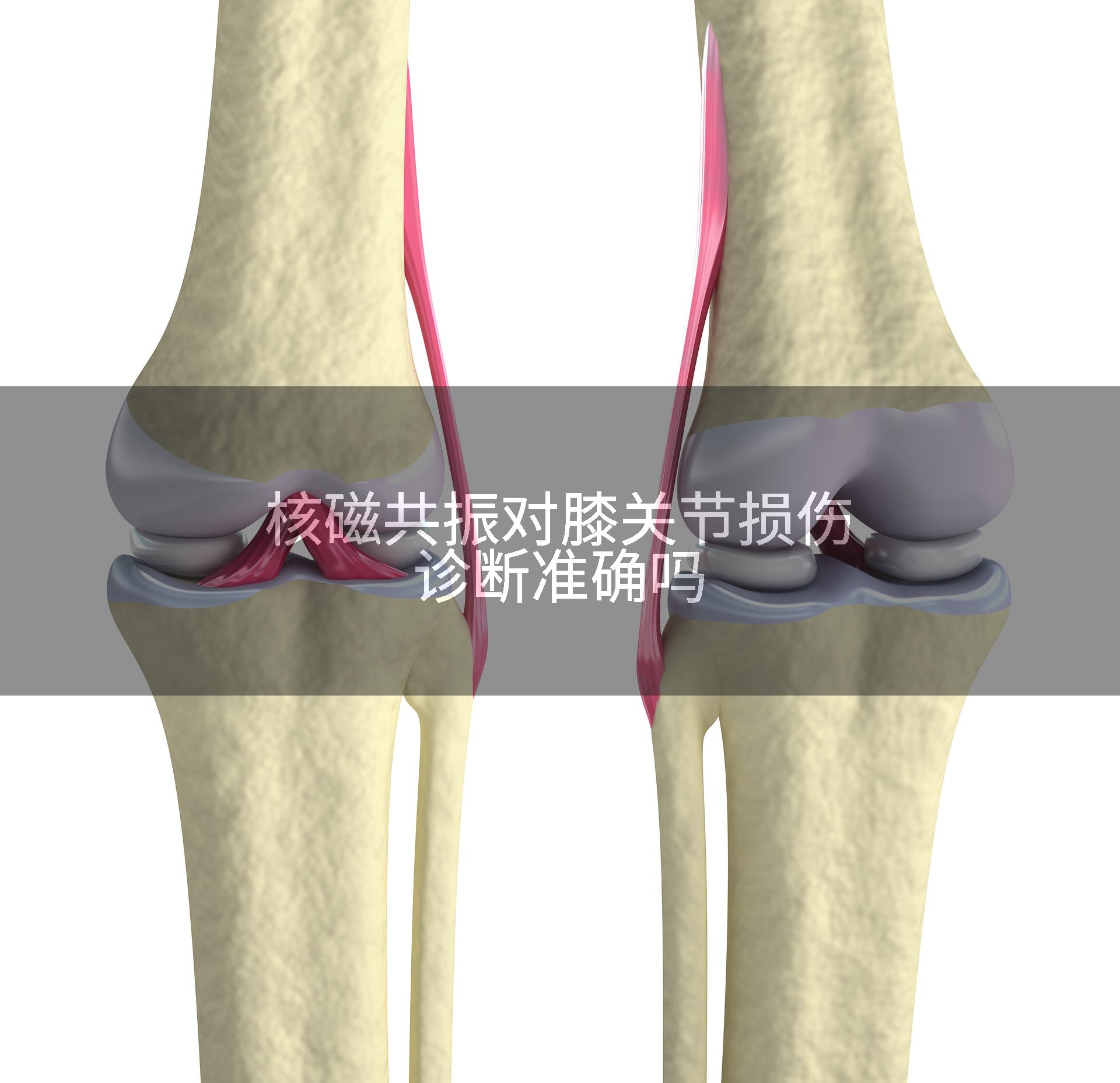 核磁共振对膝关节损伤诊断准确吗