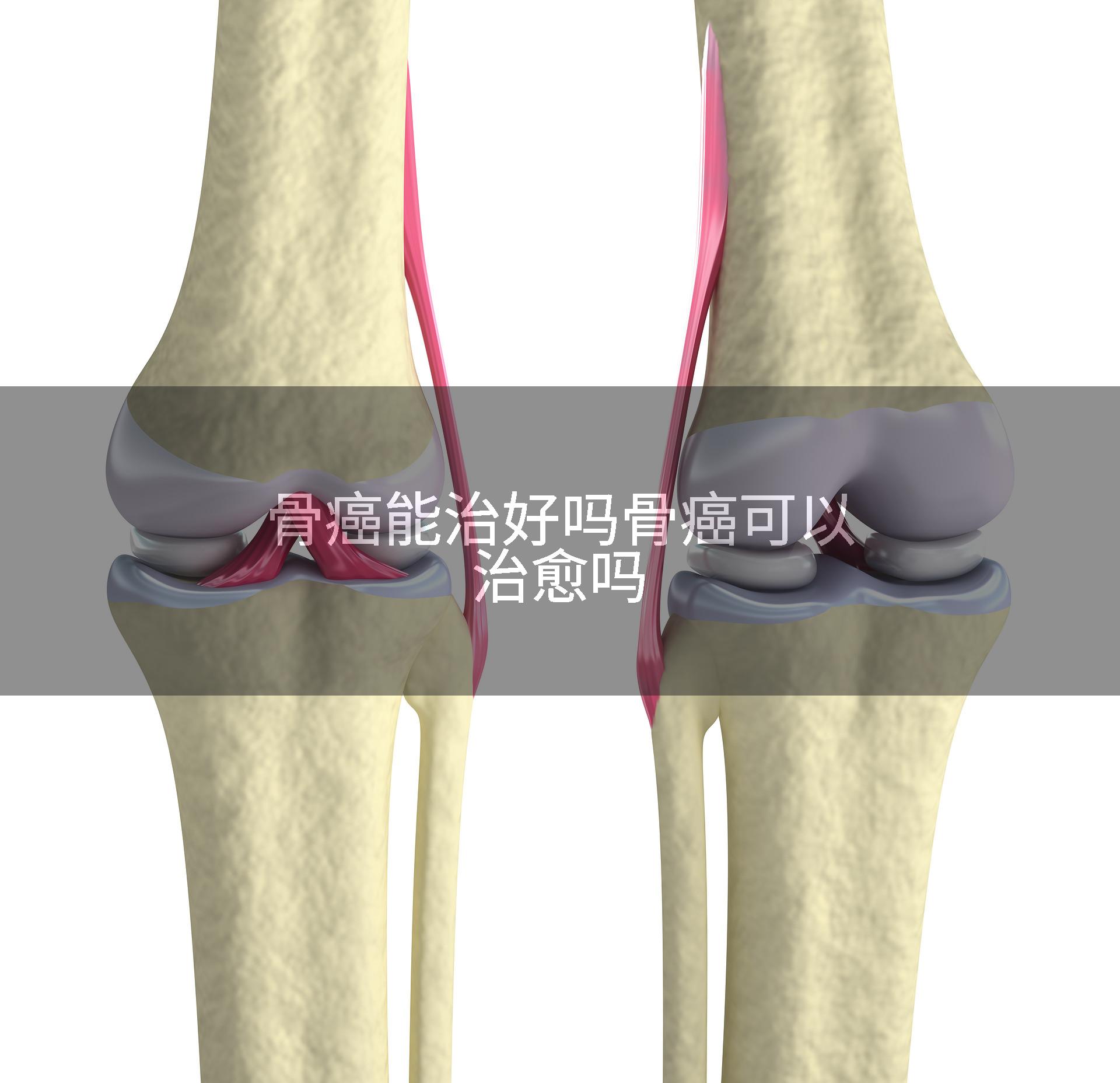 骨癌能治好吗骨癌可以治愈吗