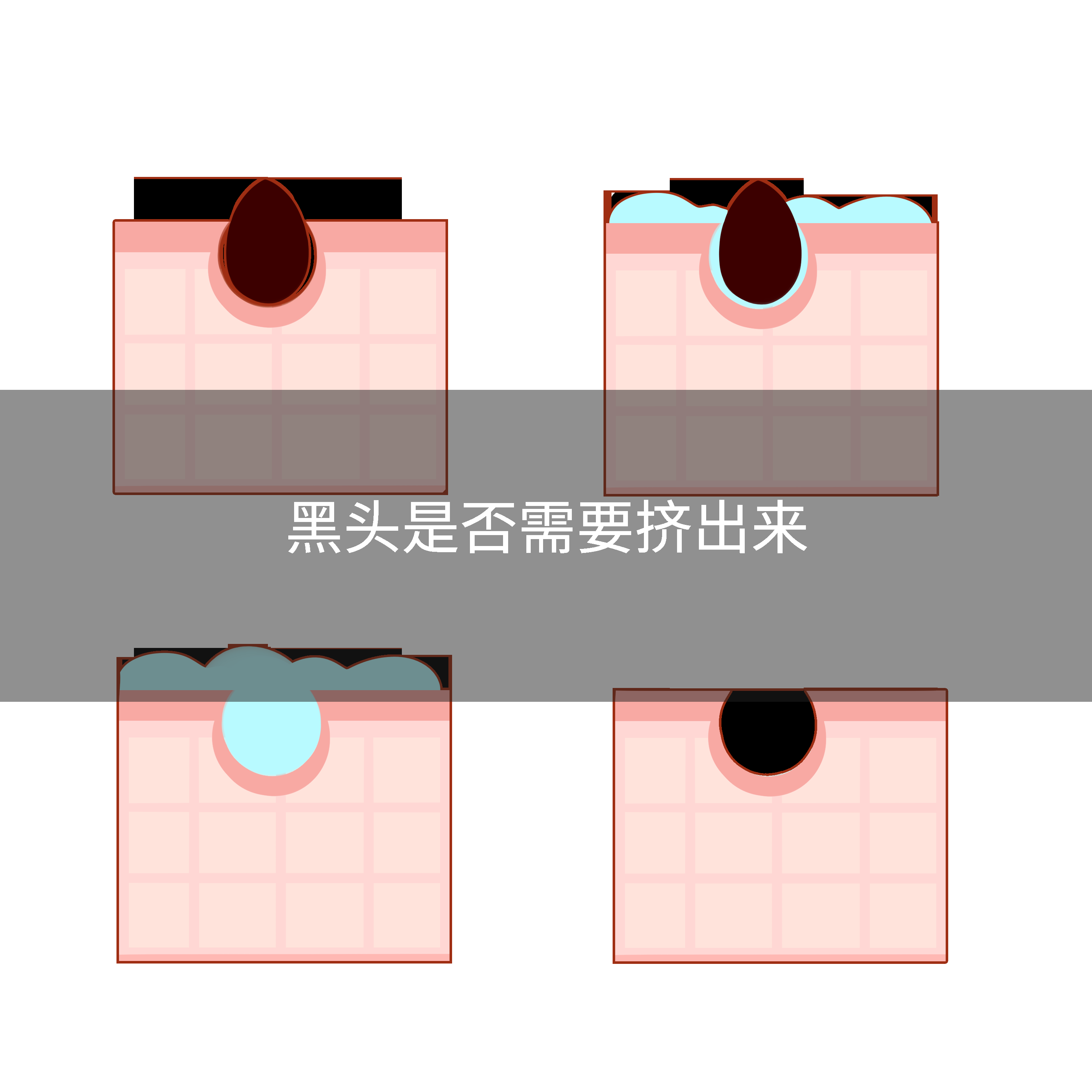 黑头是否需要挤出来