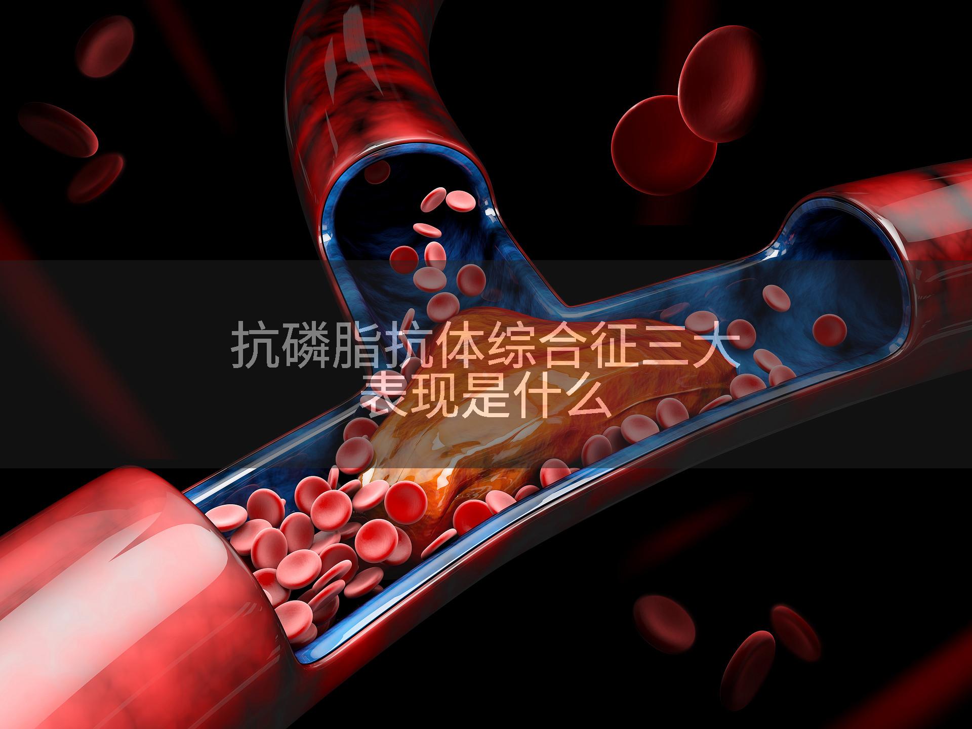 抗磷脂抗体综合征三大表现是什么
