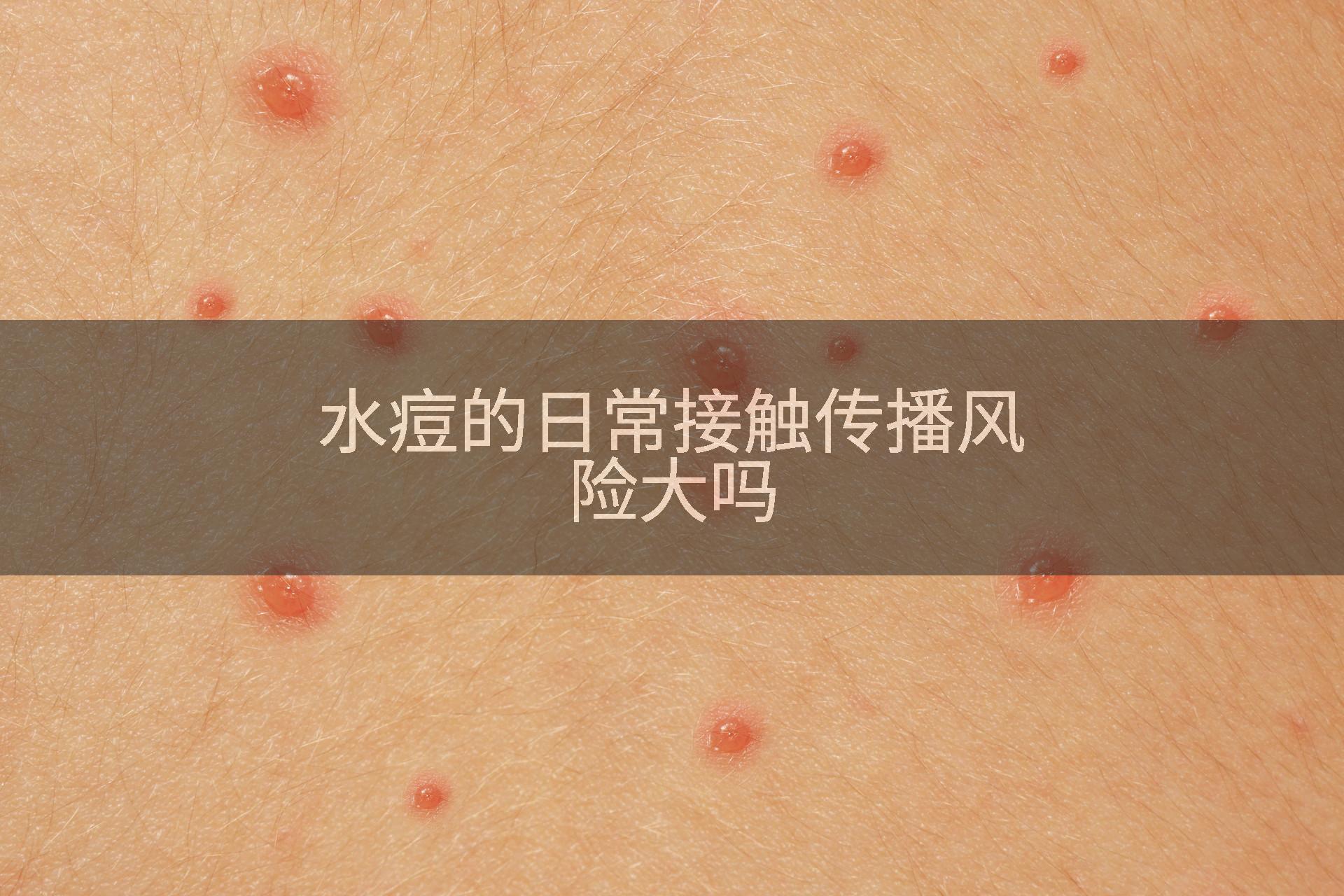水痘的日常接触传播风险大吗