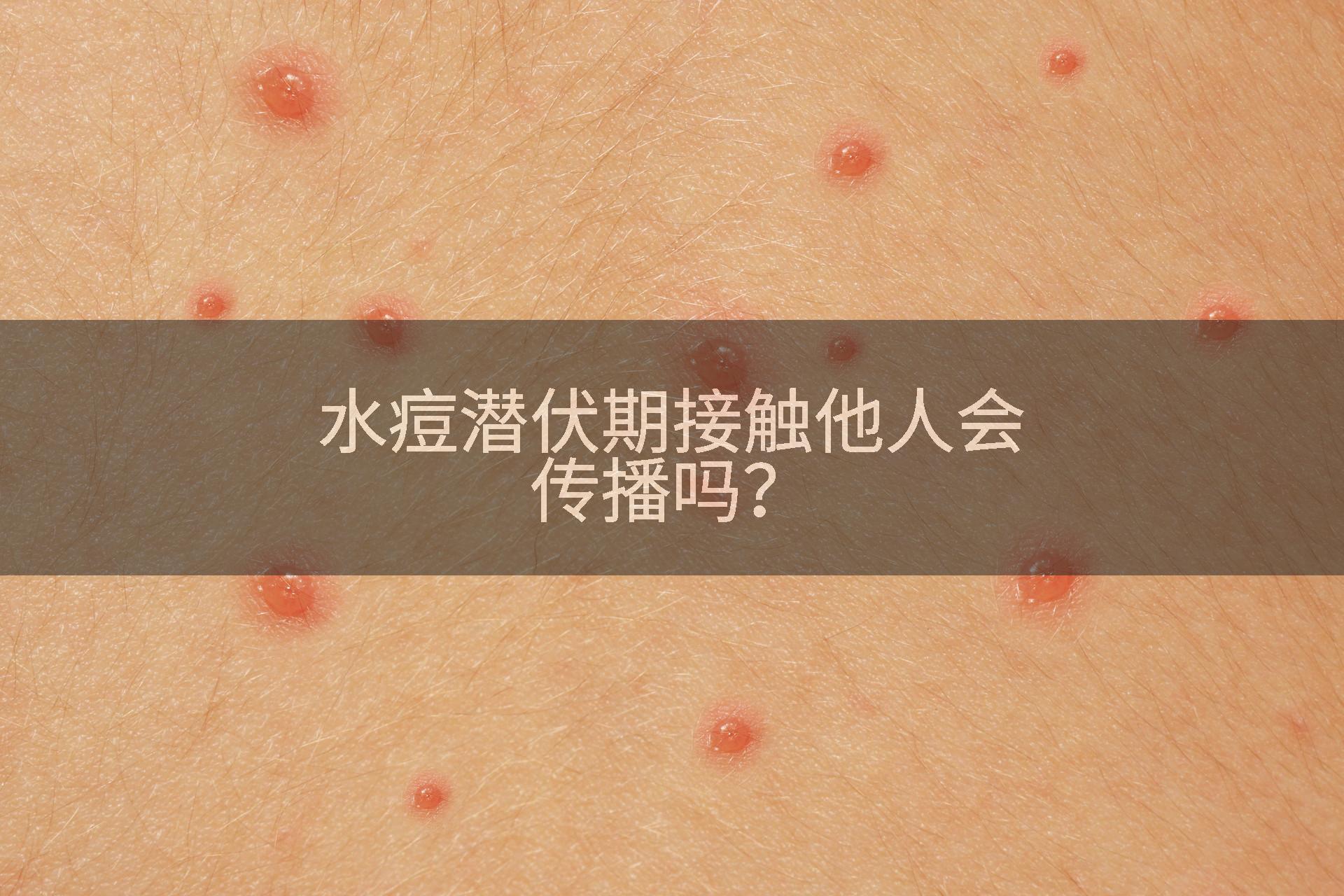 水痘潜伏期接触他人会传播吗？