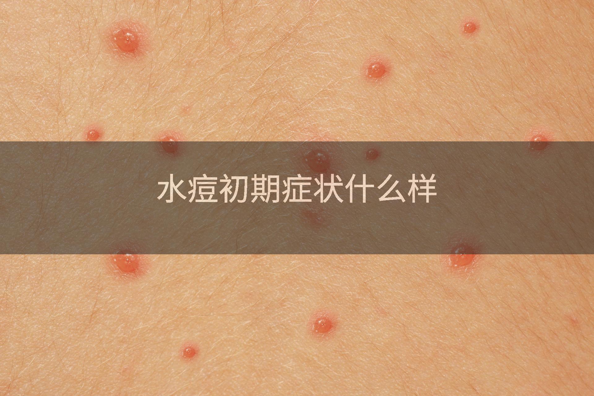 水痘初期症状什么样