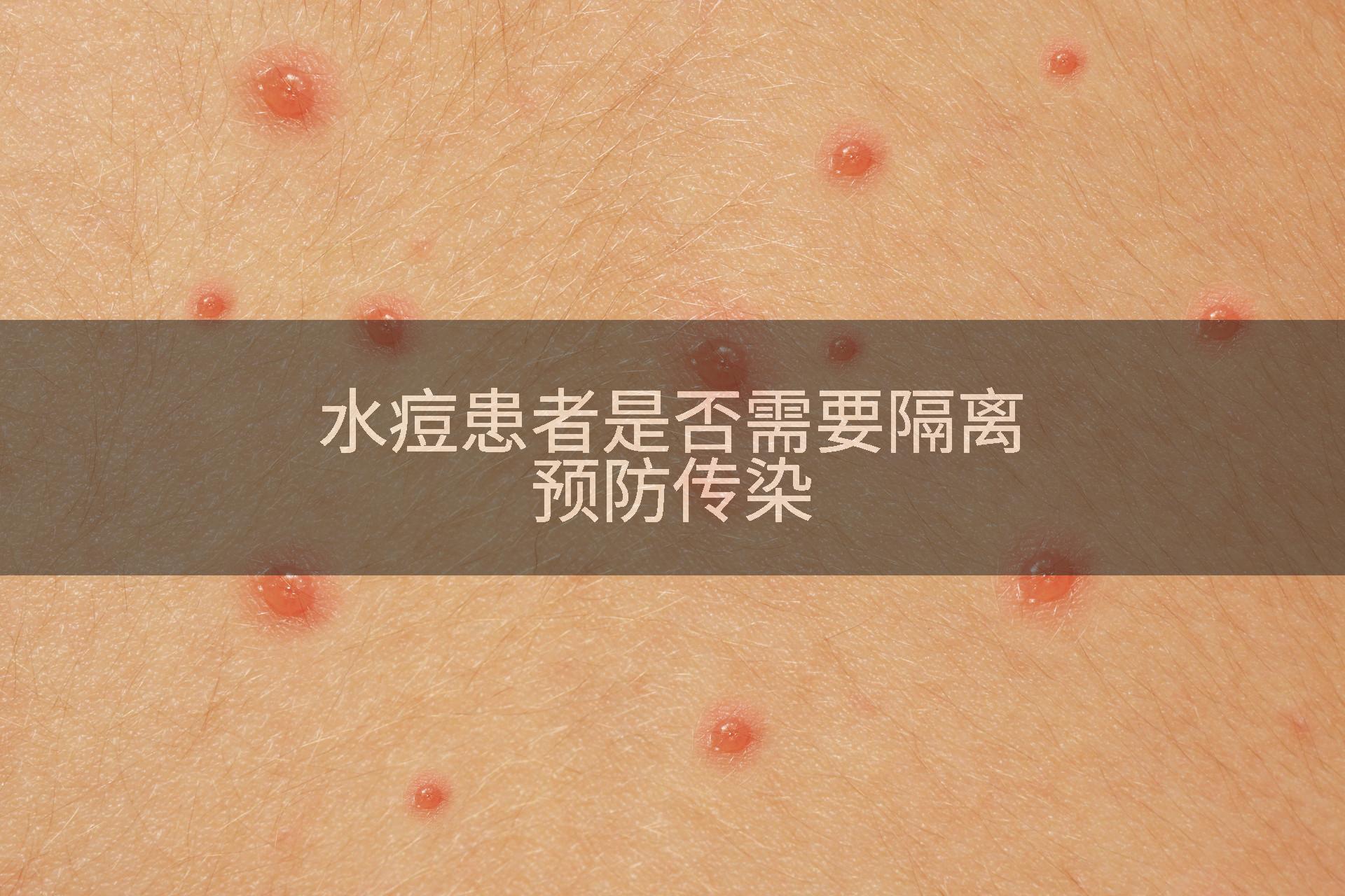 水痘患者是否需要隔离预防传染