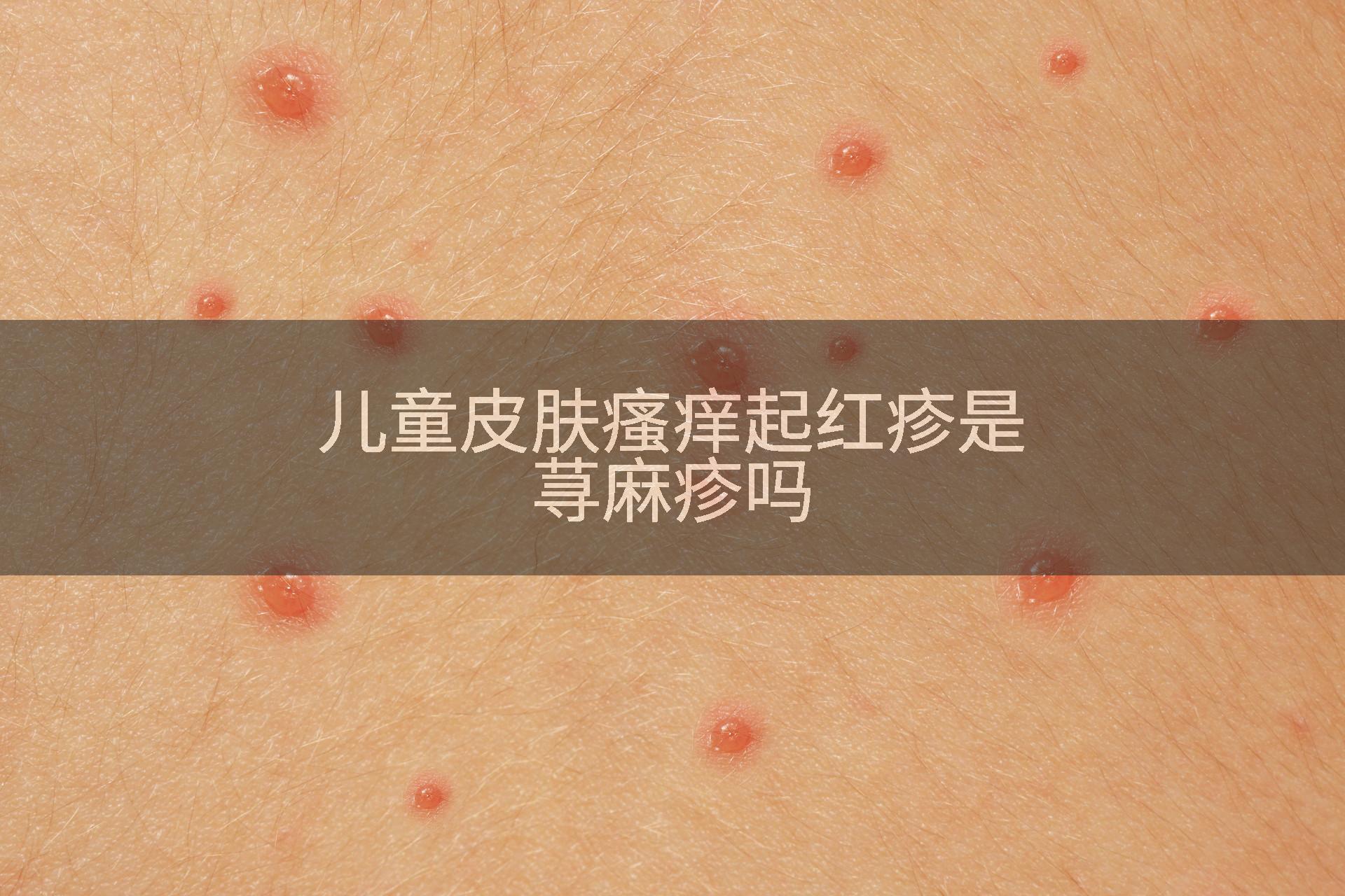 儿童皮肤瘙痒起红疹是荨麻疹吗