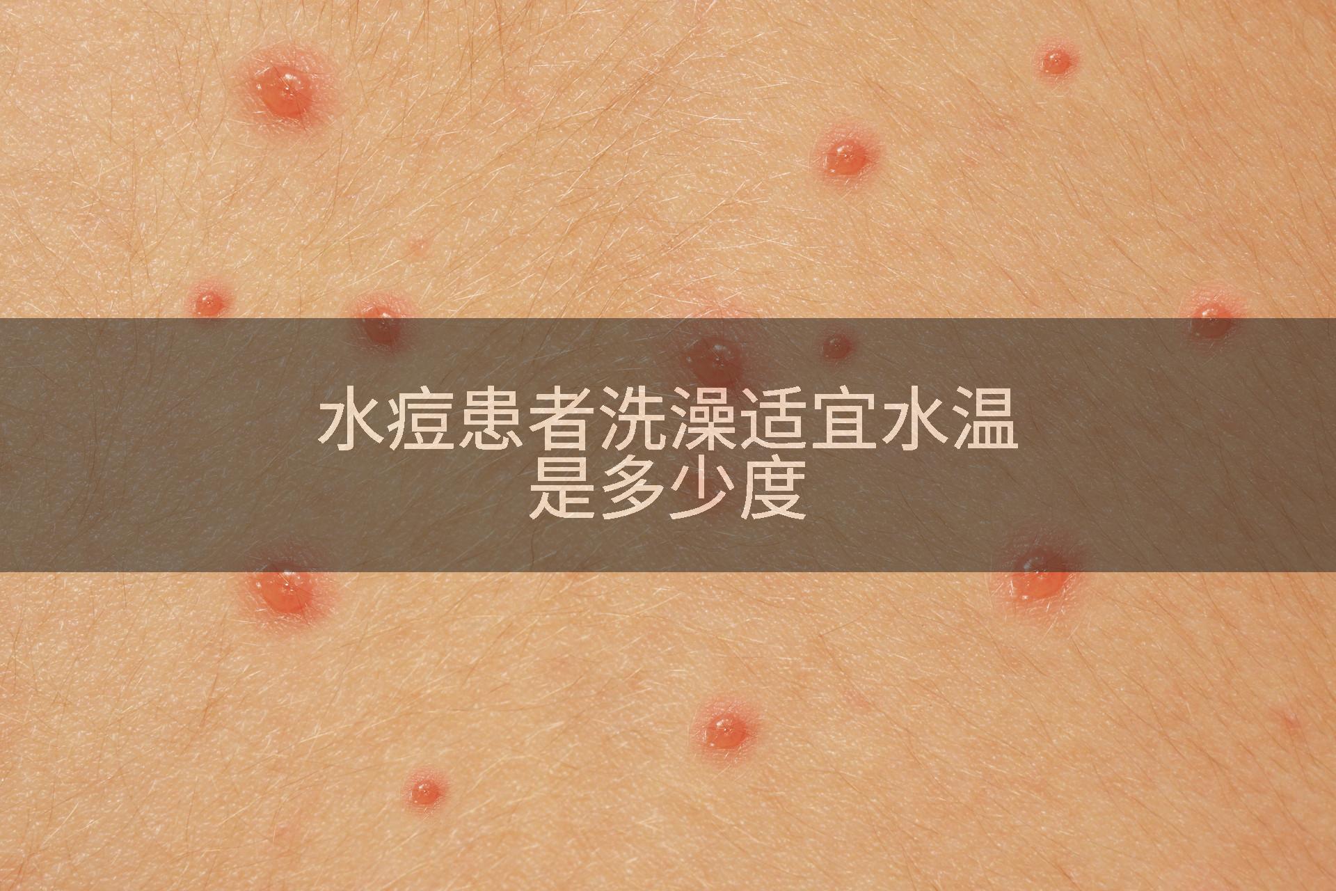 水痘患者洗澡适宜水温是多少度
