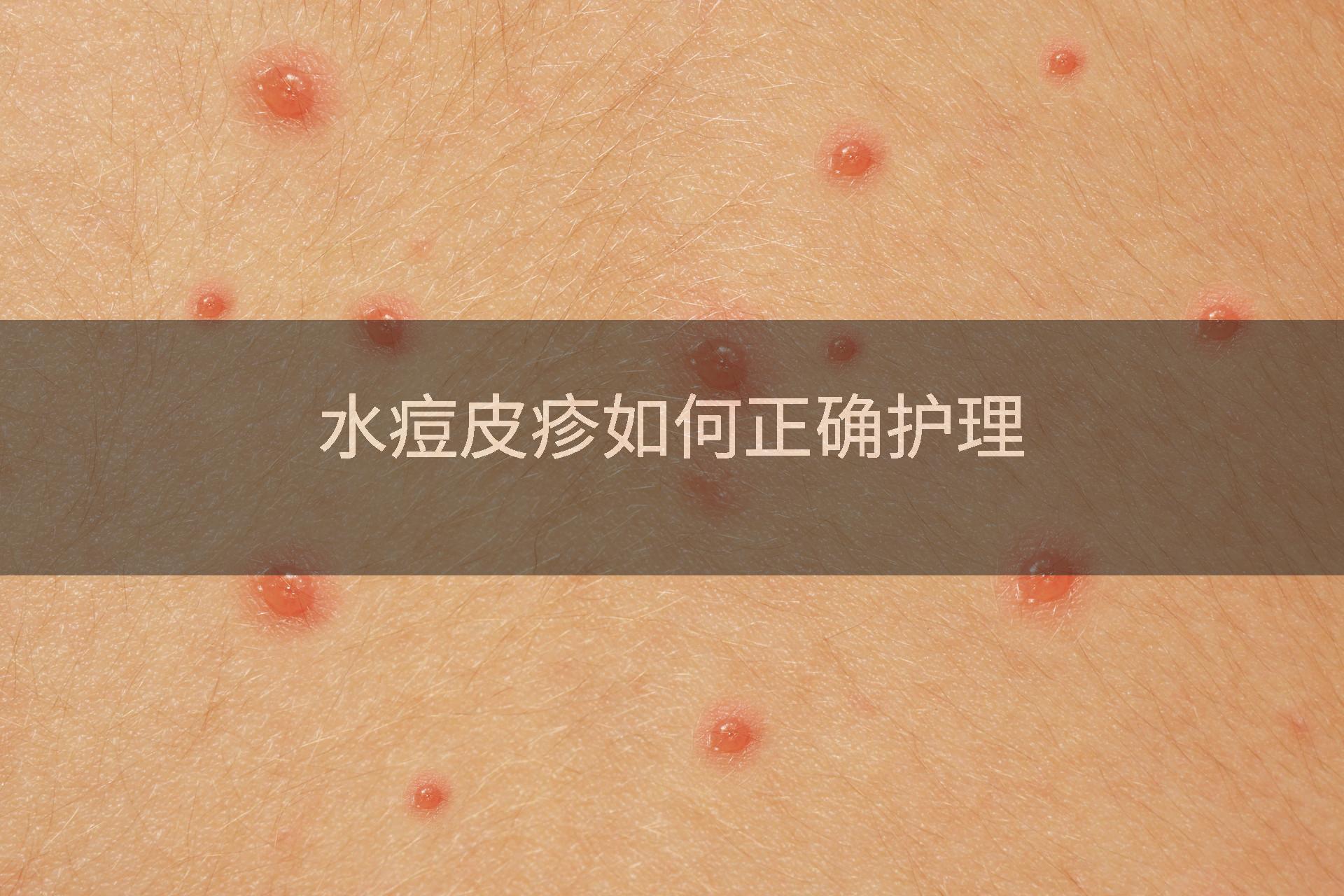 水痘皮疹如何正确护理