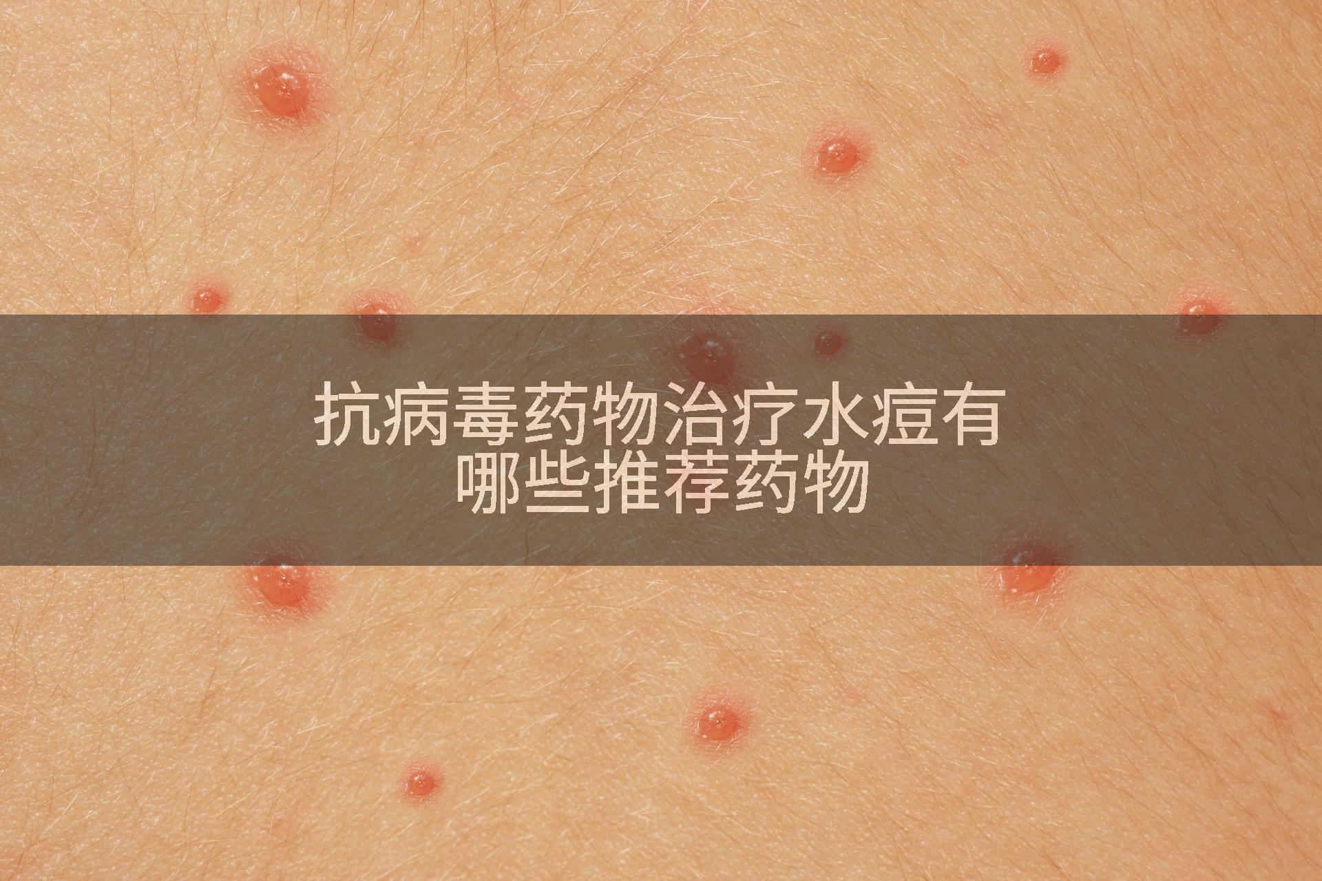抗病毒药物治疗水痘有哪些推荐药物