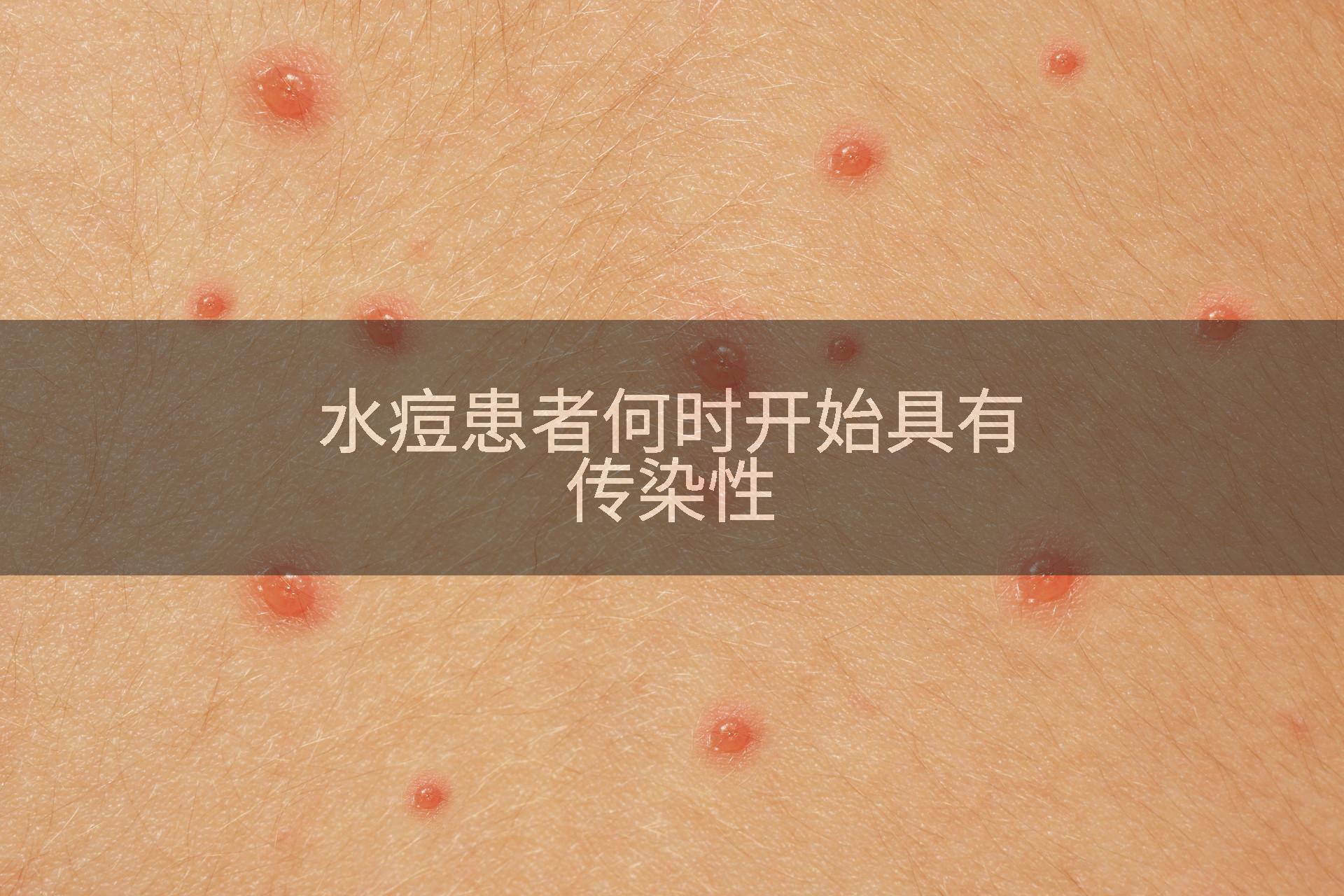 水痘患者何时开始具有传染性