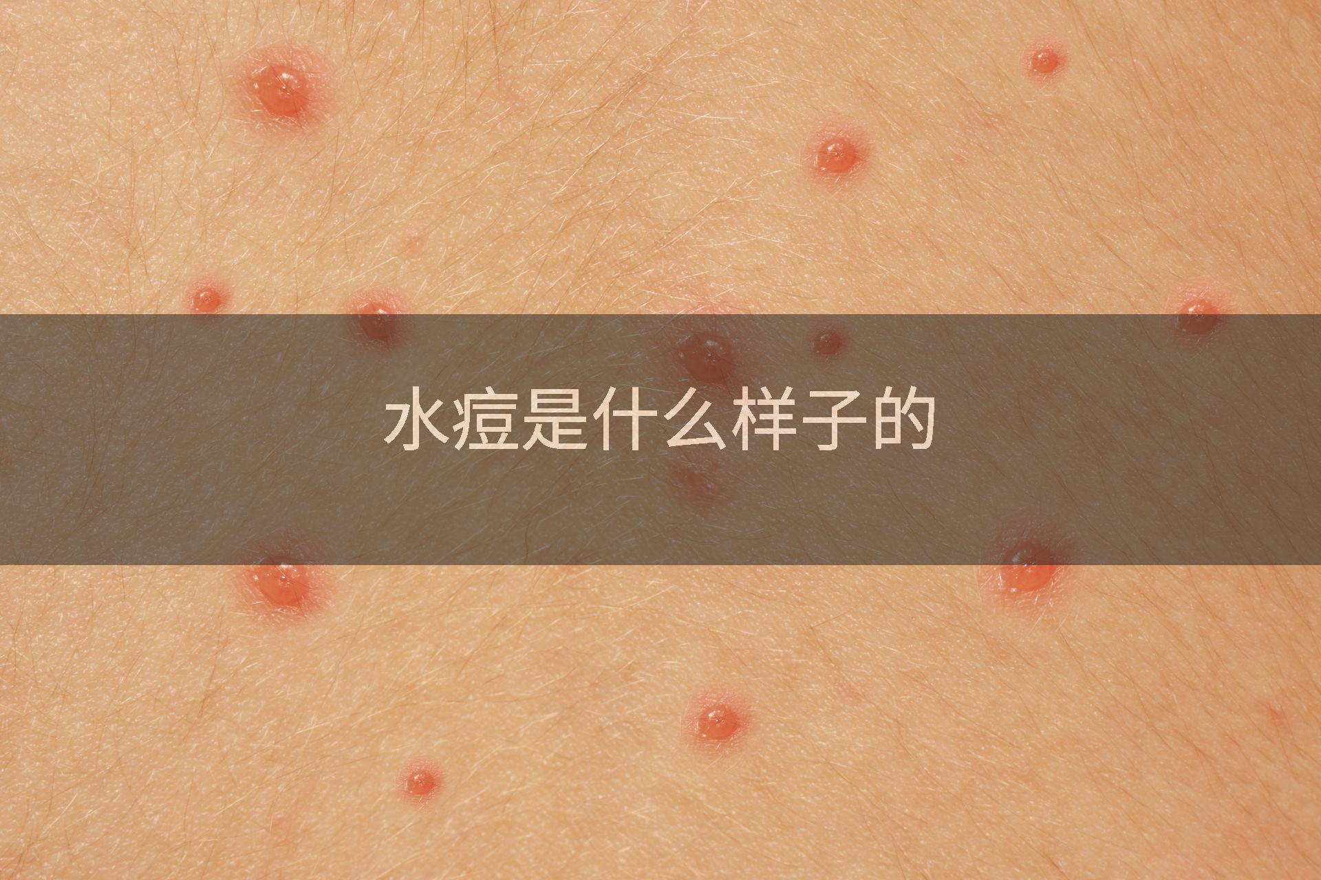 水痘是什么样子的