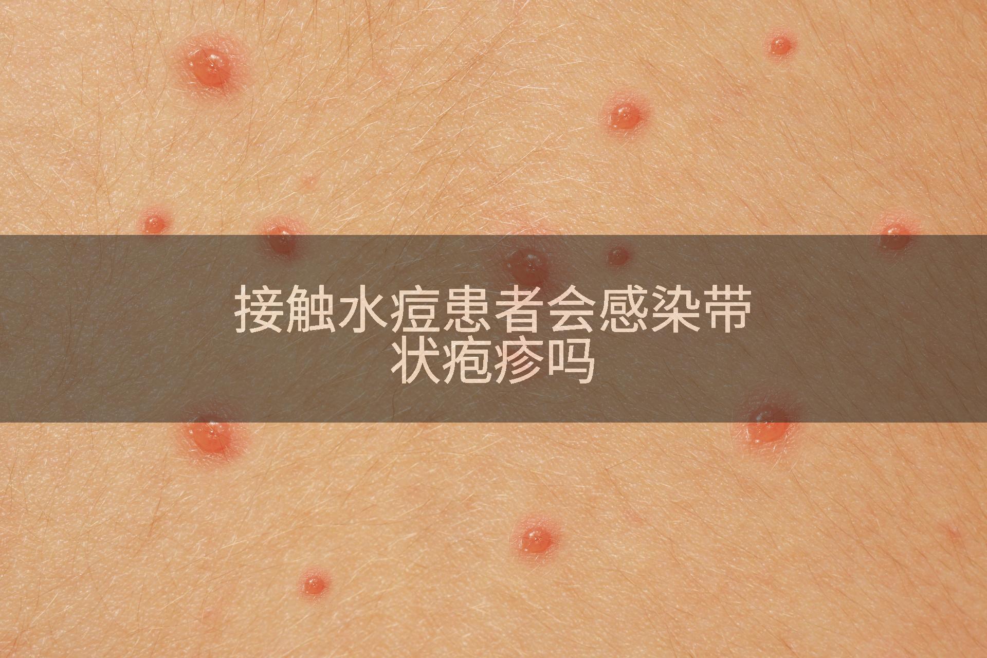 接触水痘患者会感染带状疱疹吗