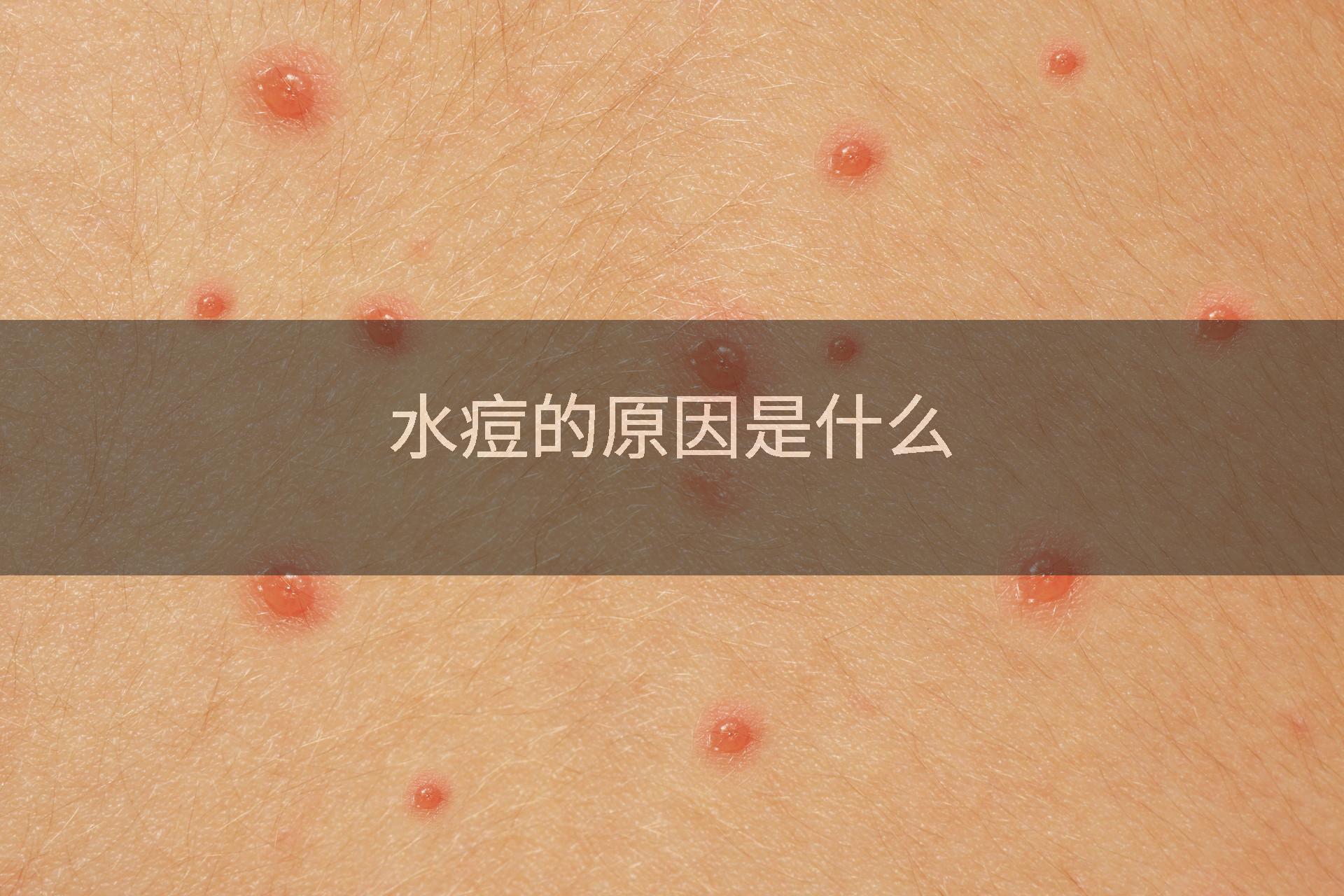 水痘的原因是什么