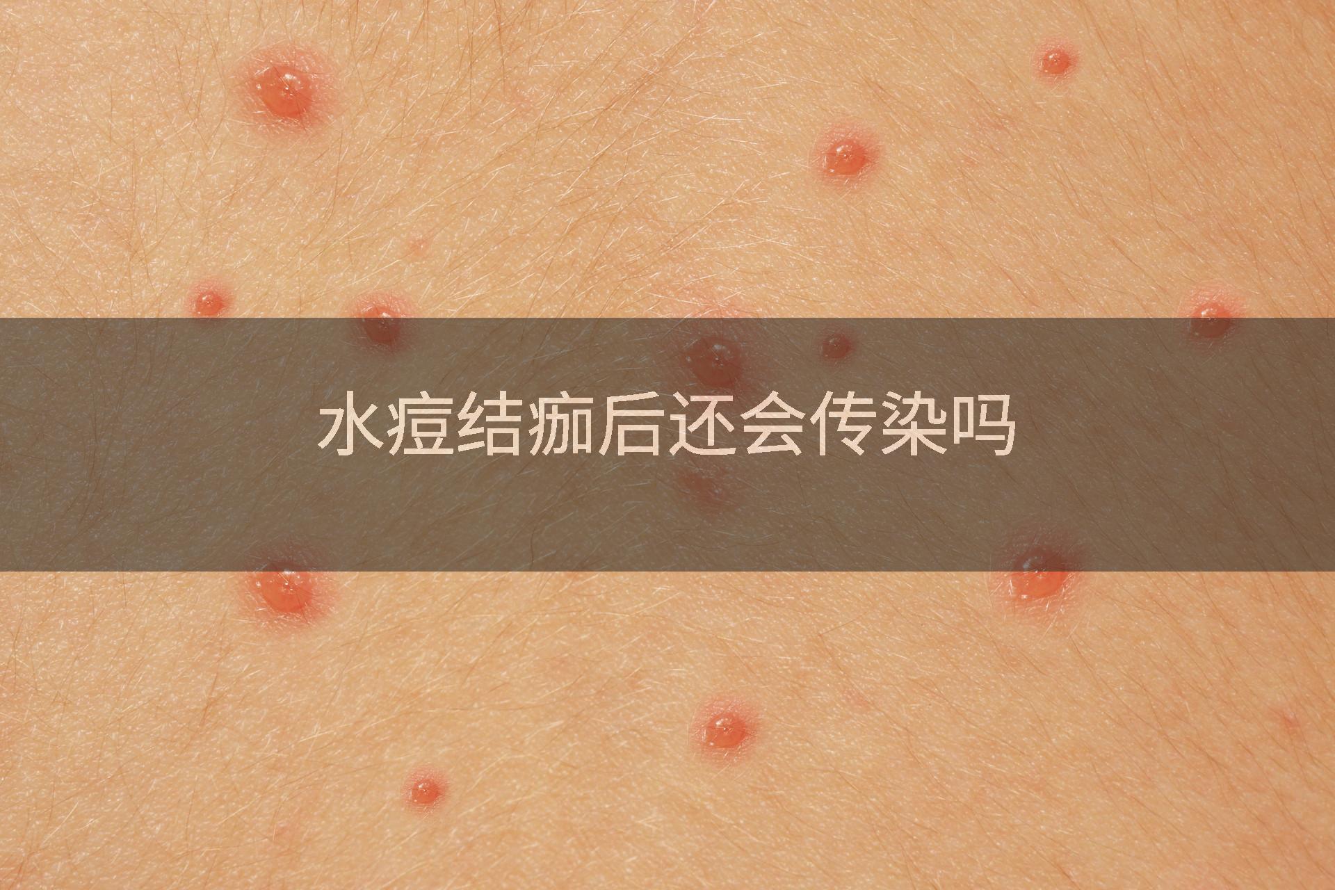 水痘结痂后还会传染吗
