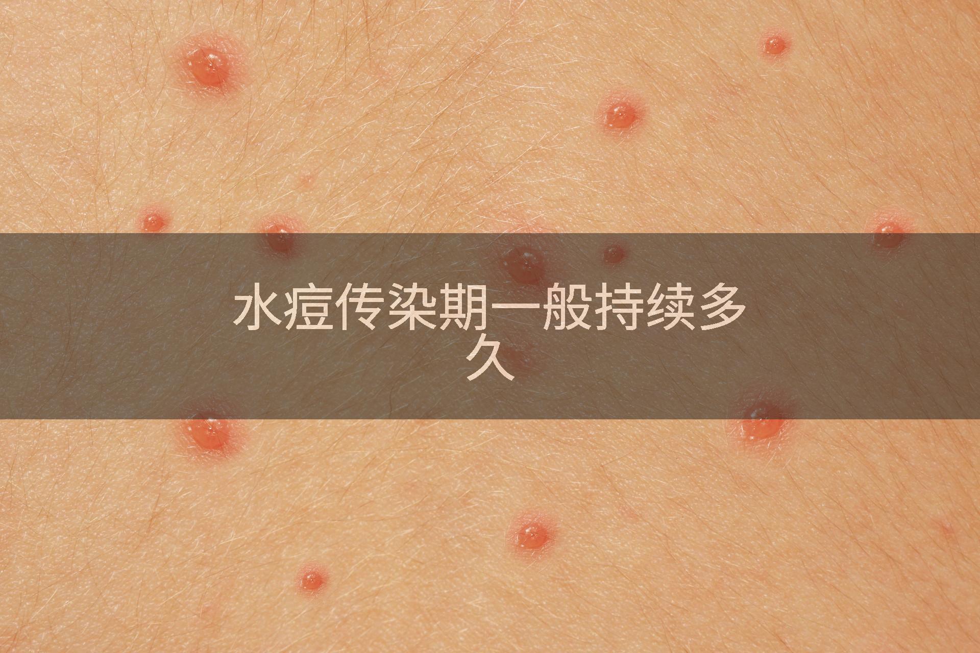 水痘传染期一般持续多久