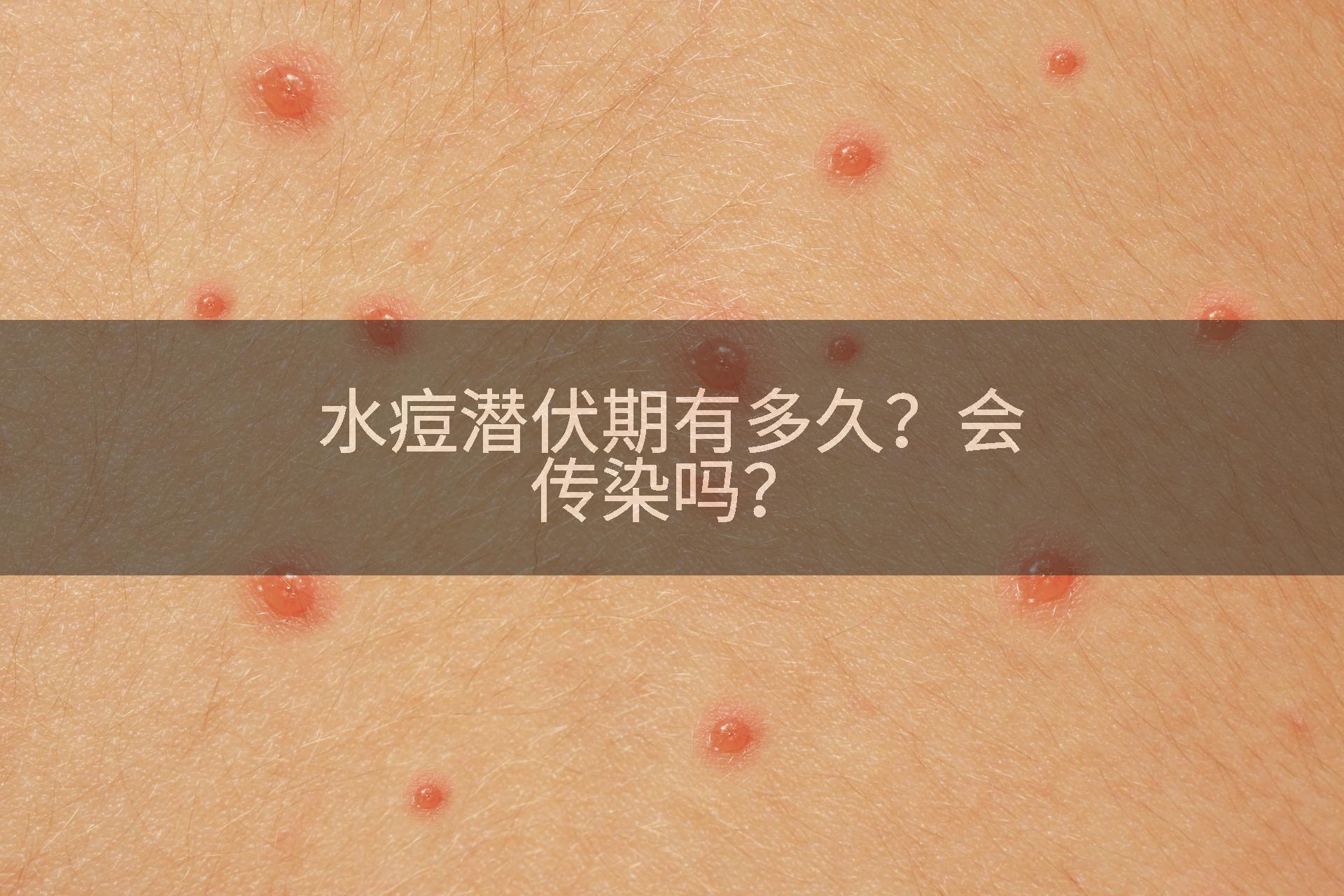 水痘潜伏期有多久？会传染吗？