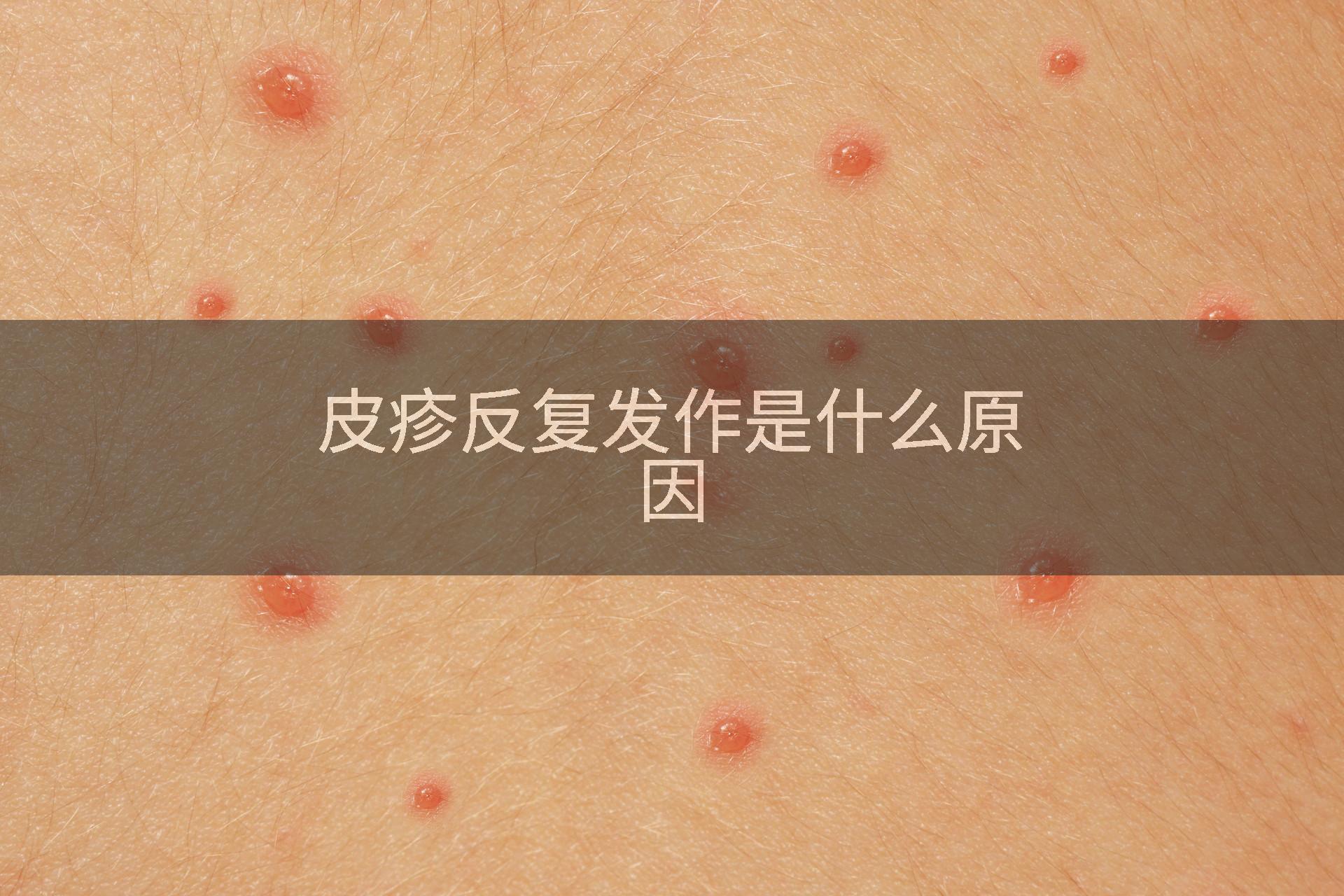皮疹反复发作是什么原因