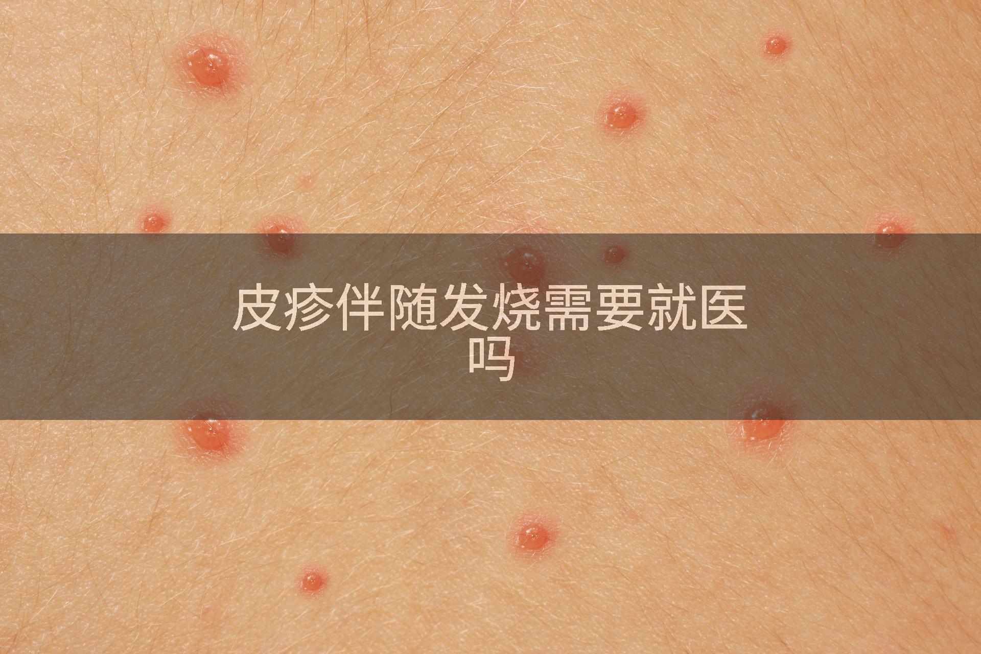 皮疹伴随发烧需要就医吗