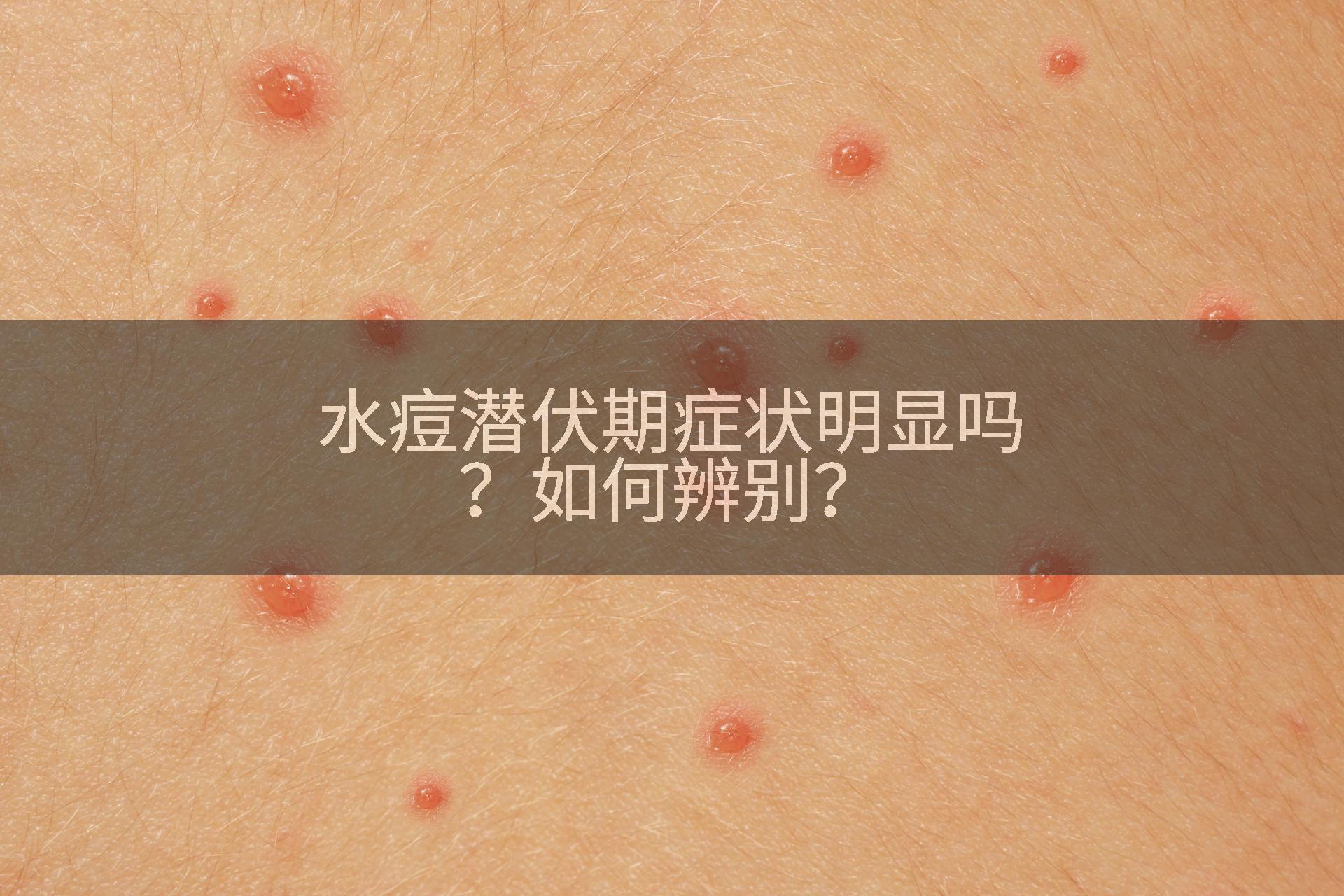 水痘潜伏期症状明显吗？如何辨别？