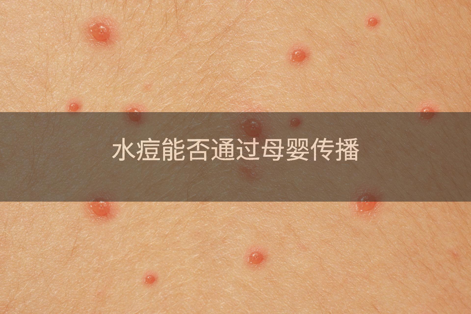水痘能否通过母婴传播