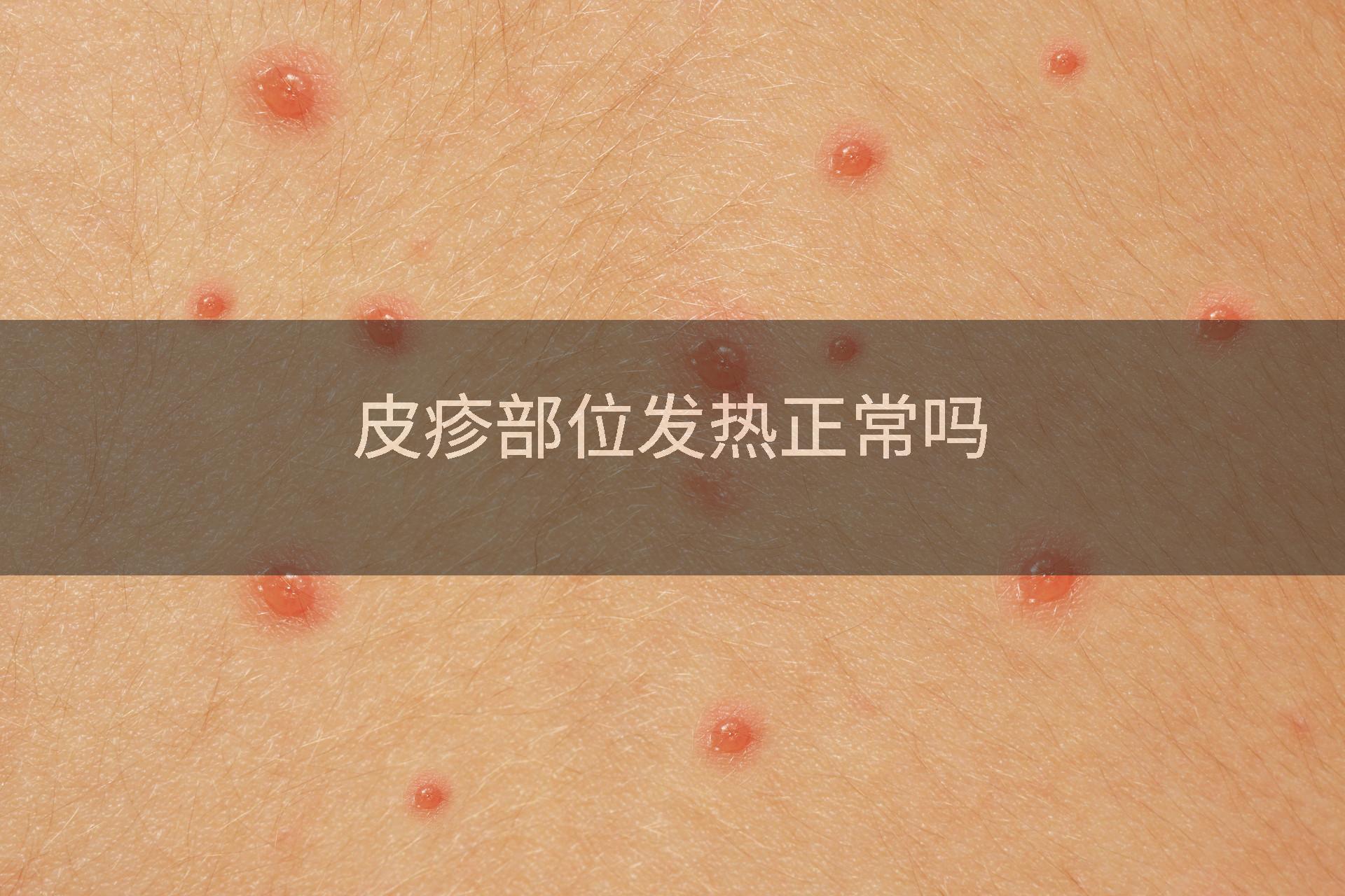 皮疹部位发热正常吗