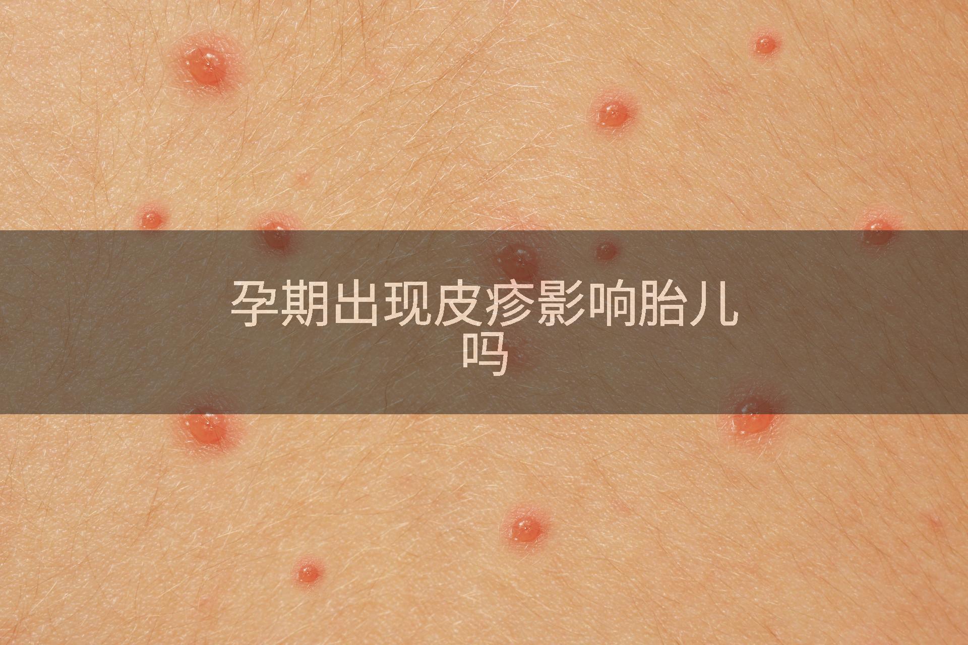 孕期出现皮疹影响胎儿吗