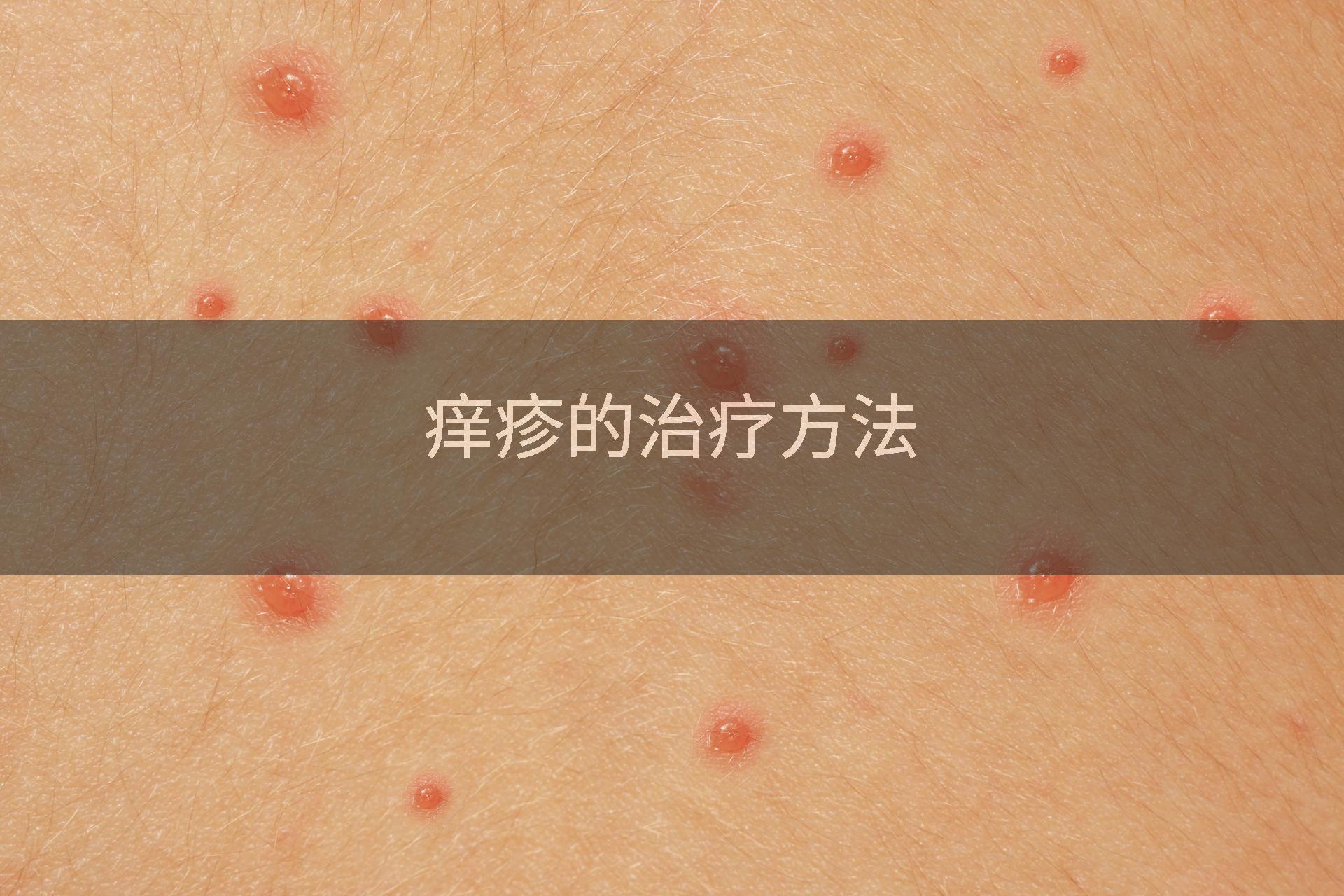 痒疹的治疗方法