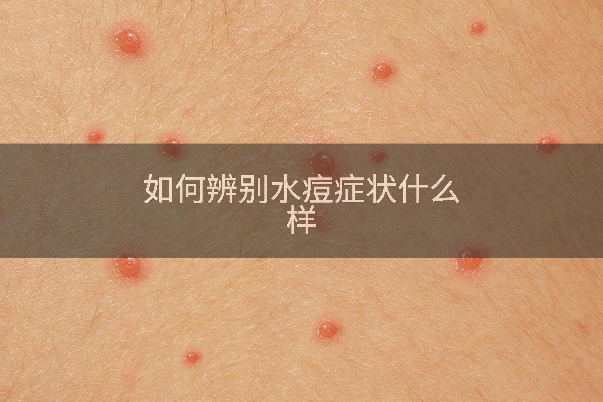 如何辨别水痘症状什么样