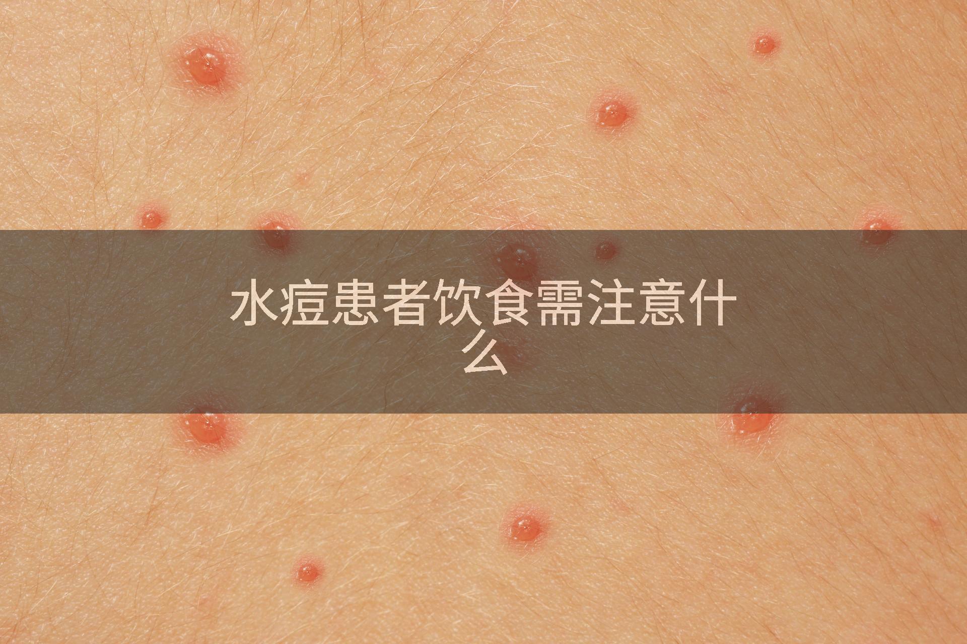水痘患者饮食需注意什么