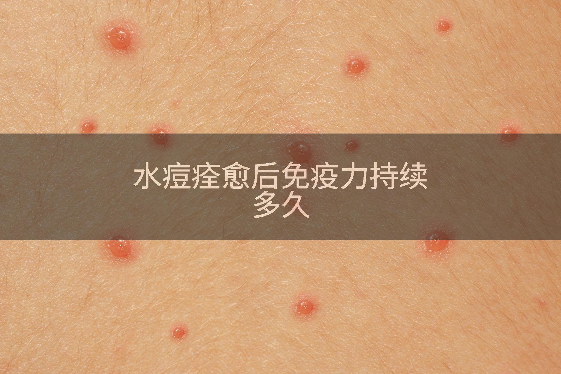 水痘痊愈后免疫力持续多久