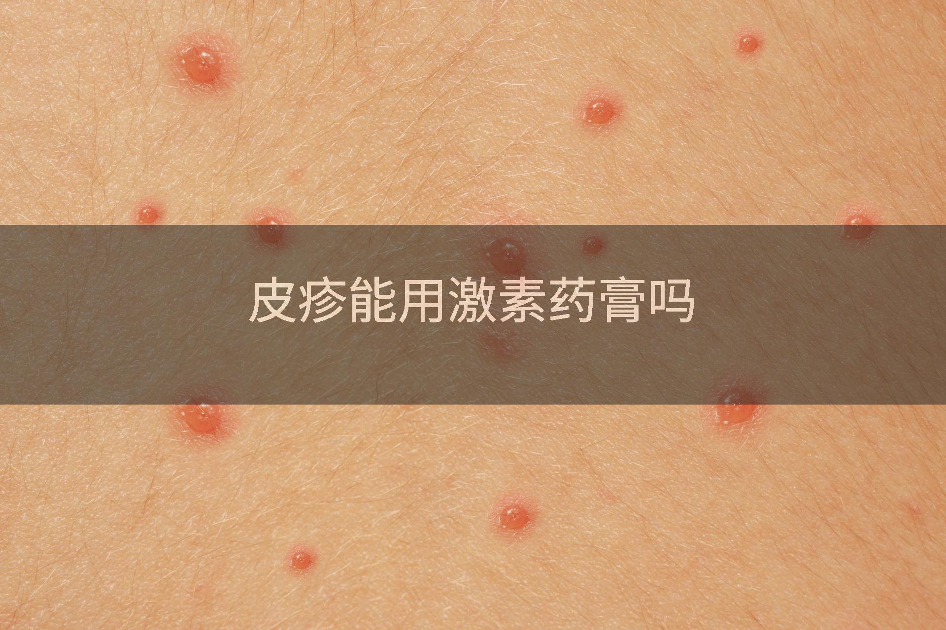 皮疹能用激素药膏吗
