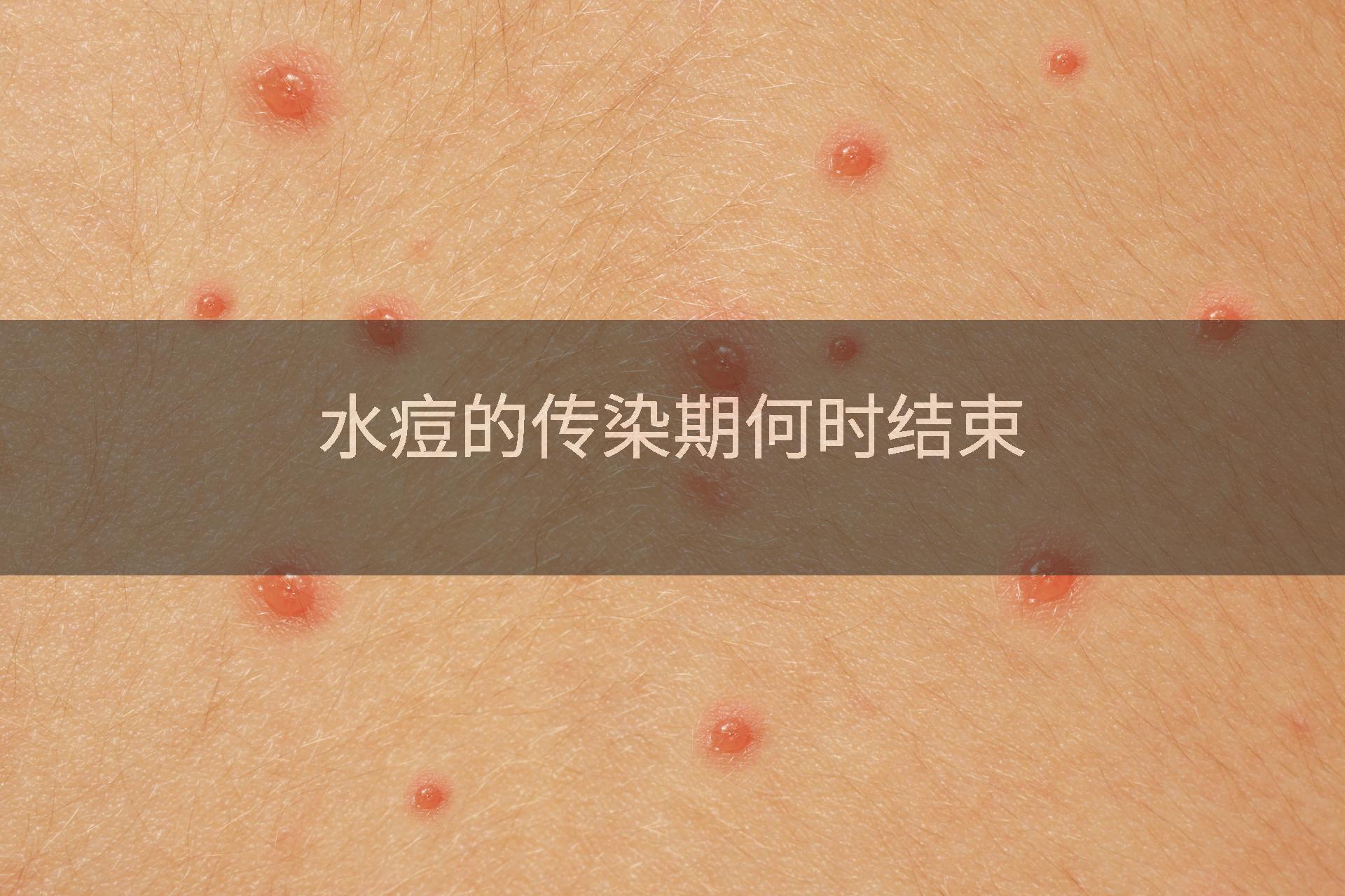 水痘的传染期何时结束