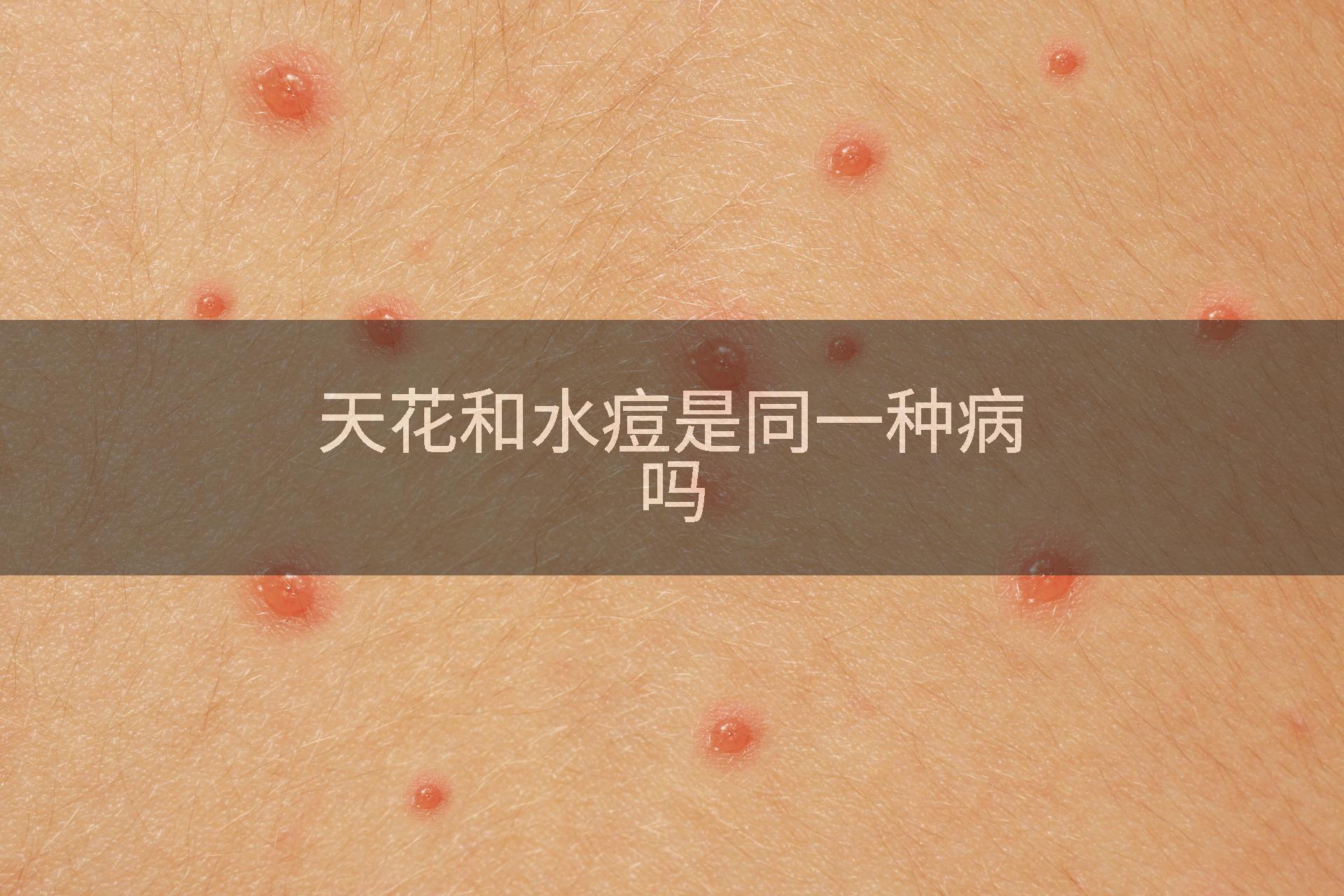 天花和水痘是同一种病吗