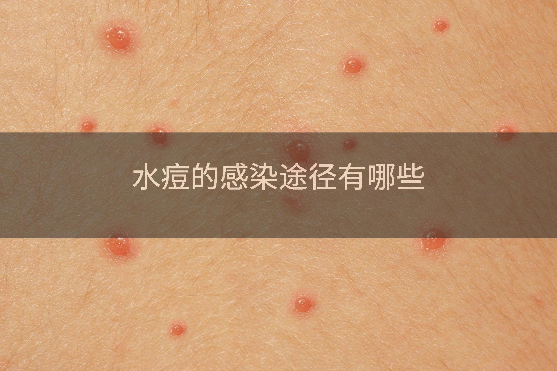 水痘的感染途径有哪些