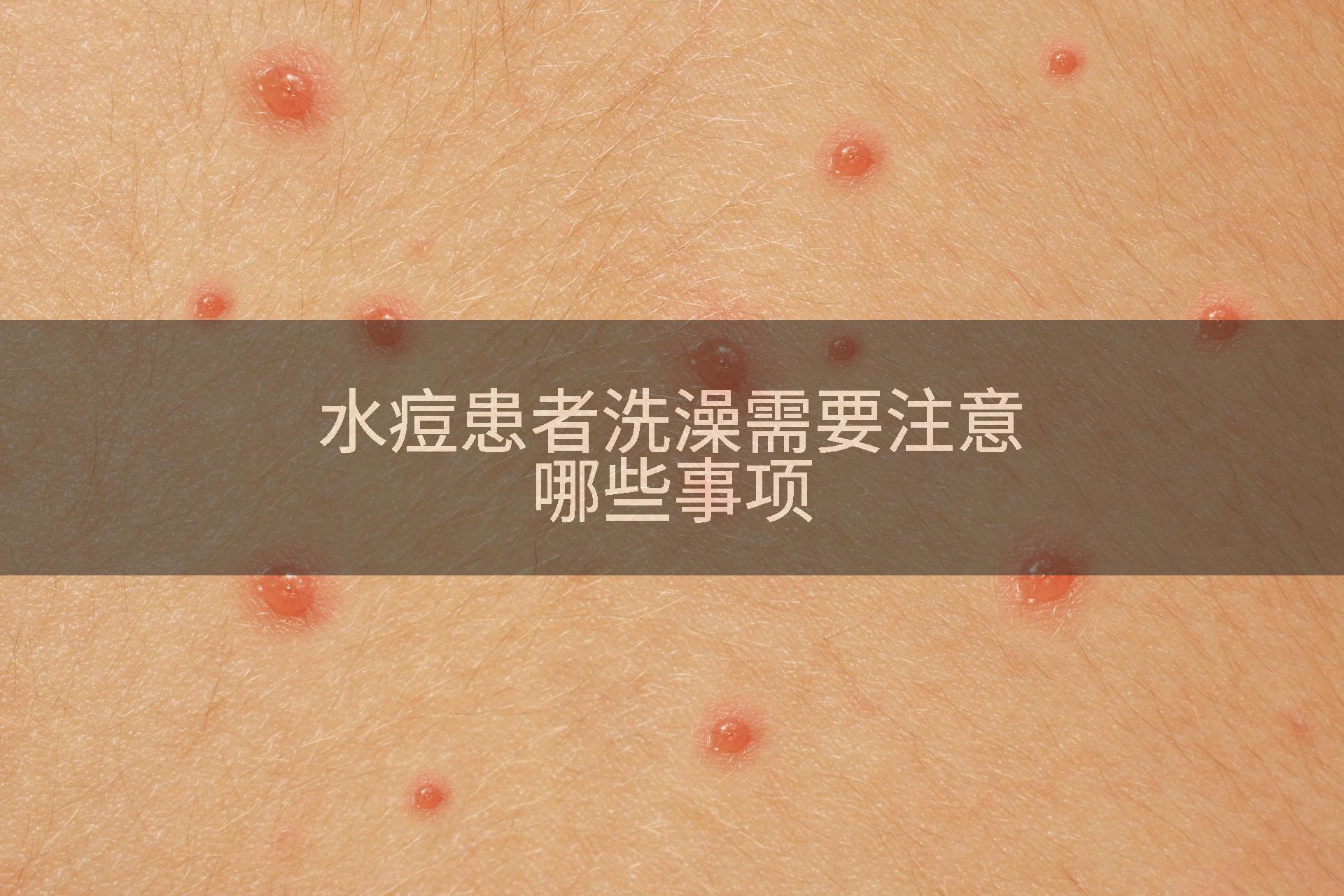 水痘患者洗澡需要注意哪些事项