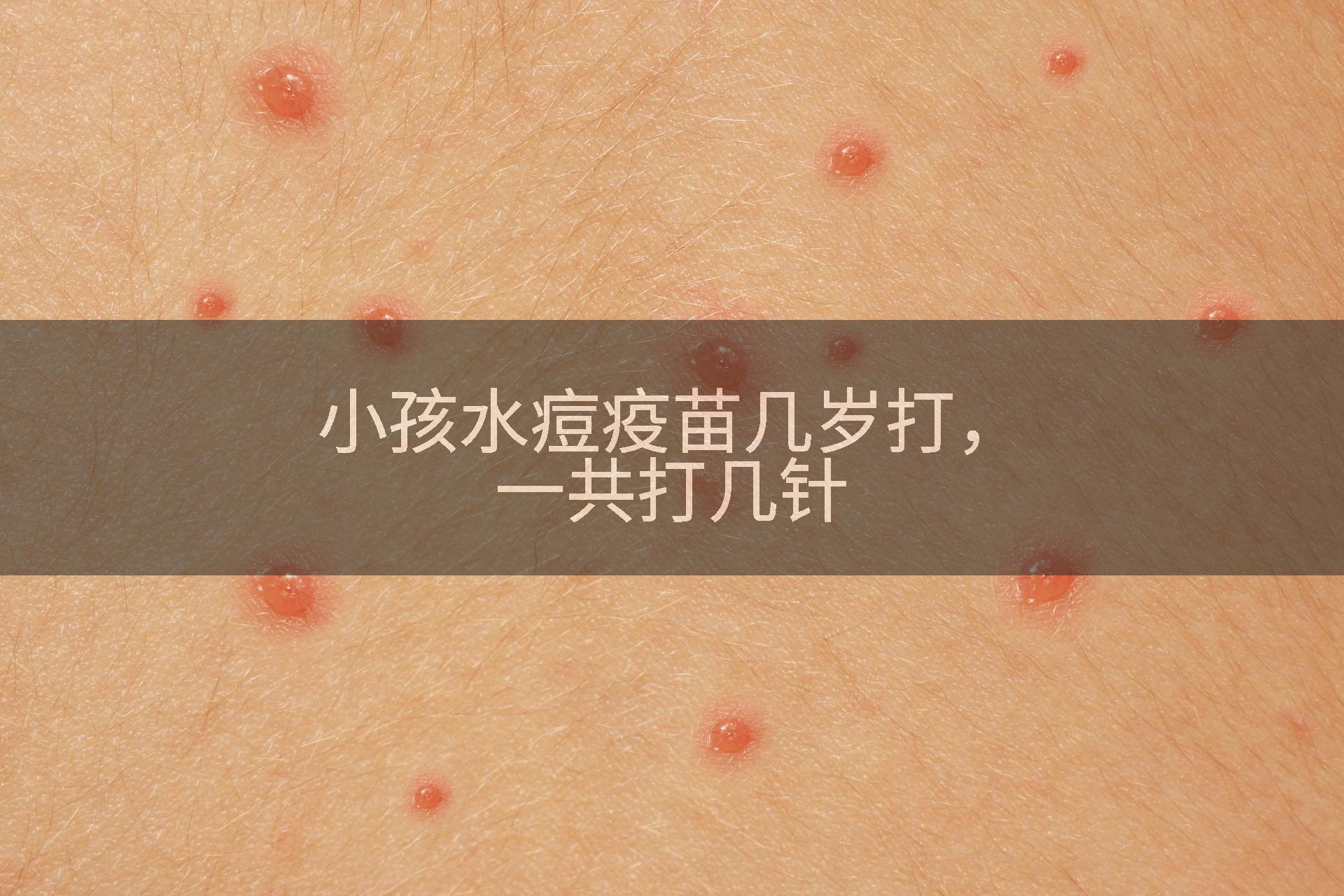 小孩水痘疫苗几岁打，一共打几针
