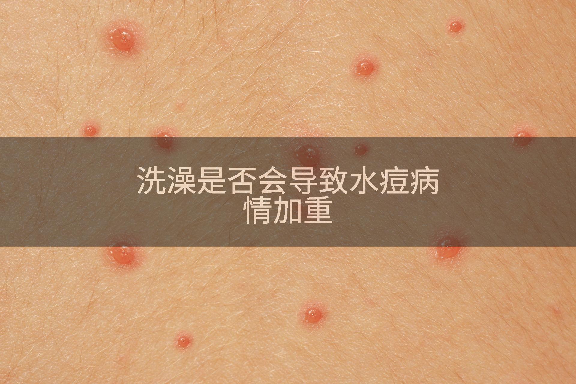洗澡是否会导致水痘病情加重