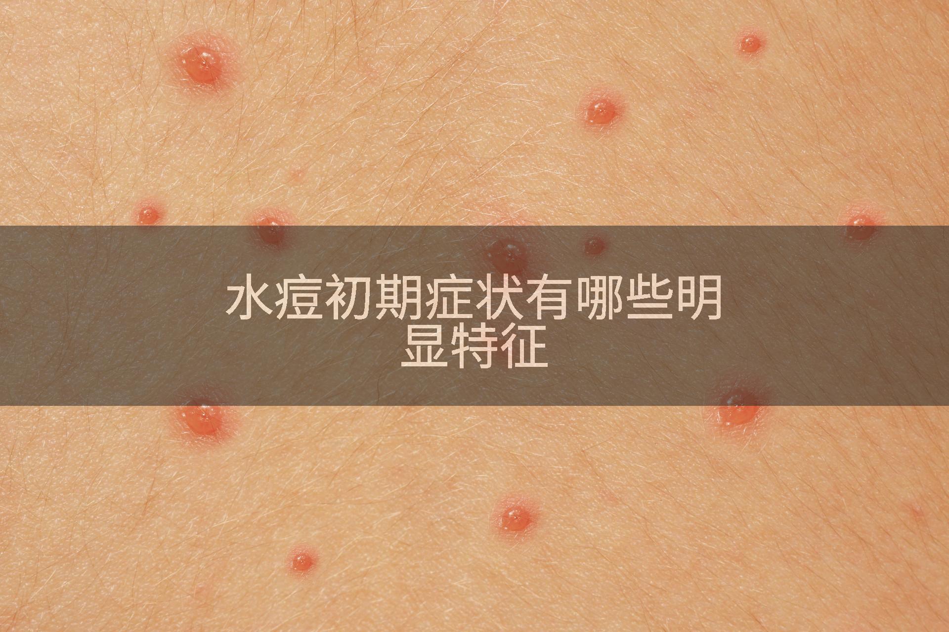 水痘初期症状有哪些明显特征