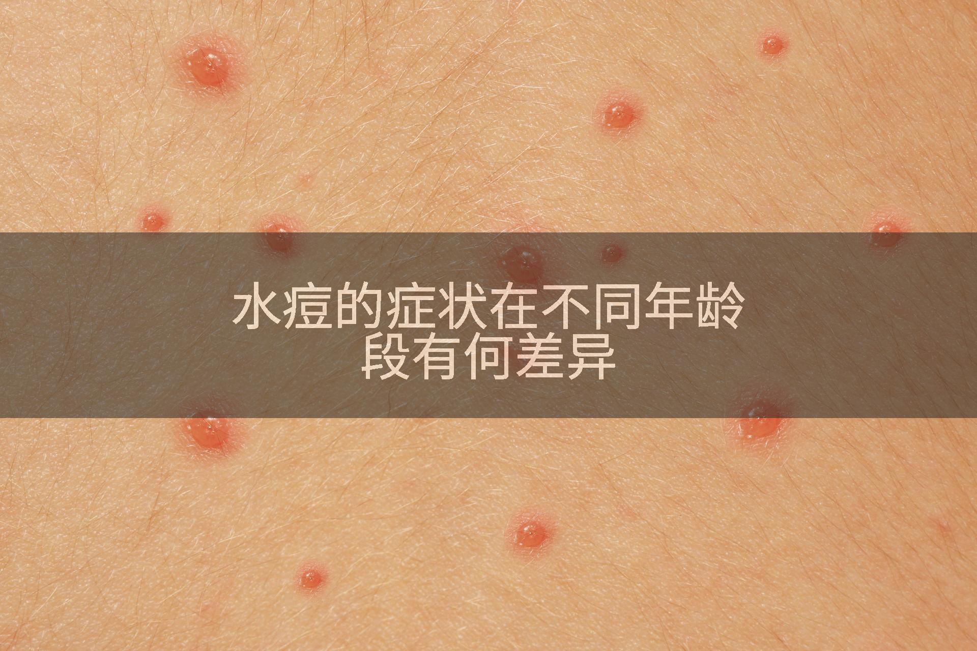 水痘的症状在不同年龄段有何差异