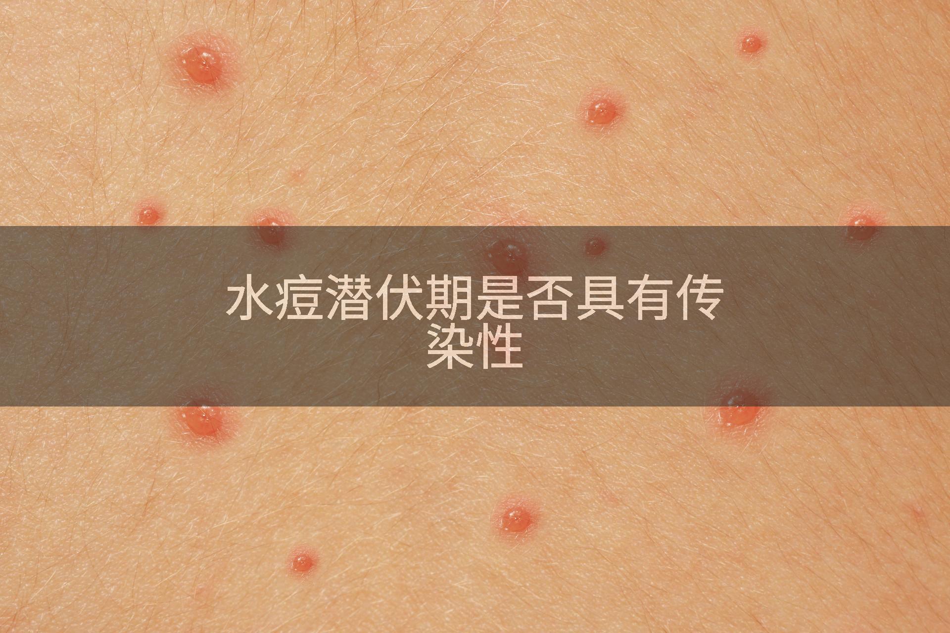 水痘潜伏期是否具有传染性