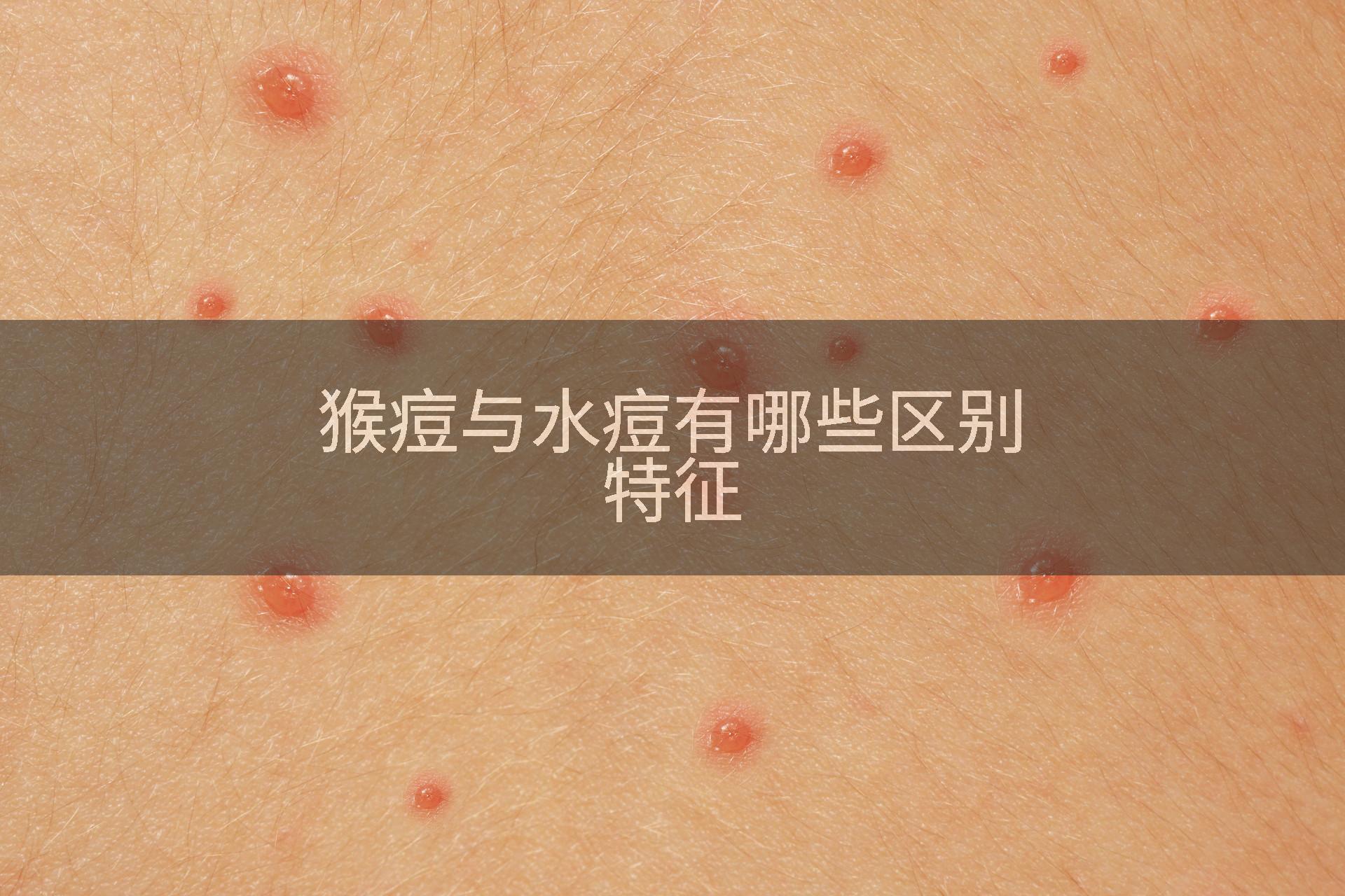 猴痘与水痘有哪些区别特征