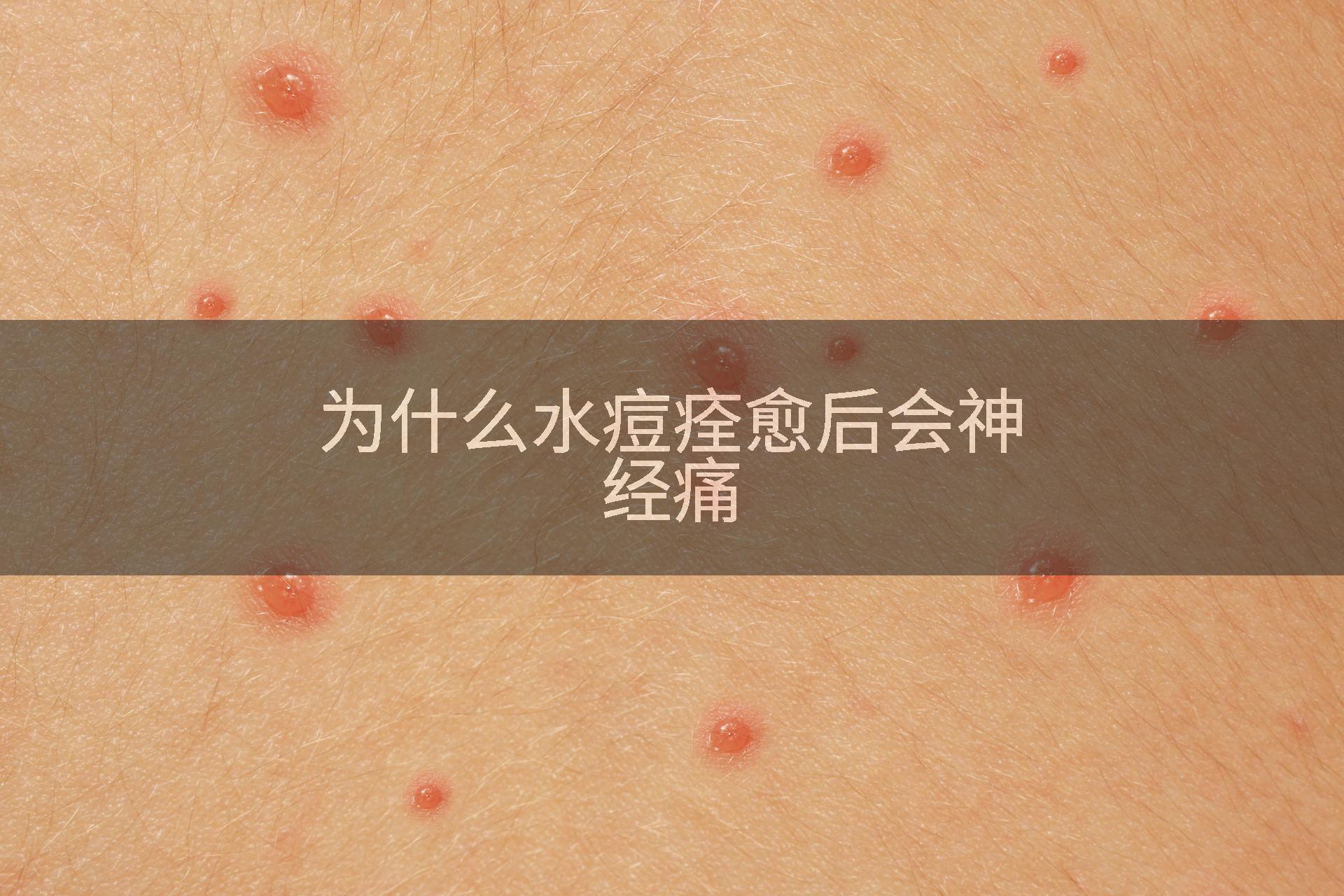 为什么水痘痊愈后会神经痛