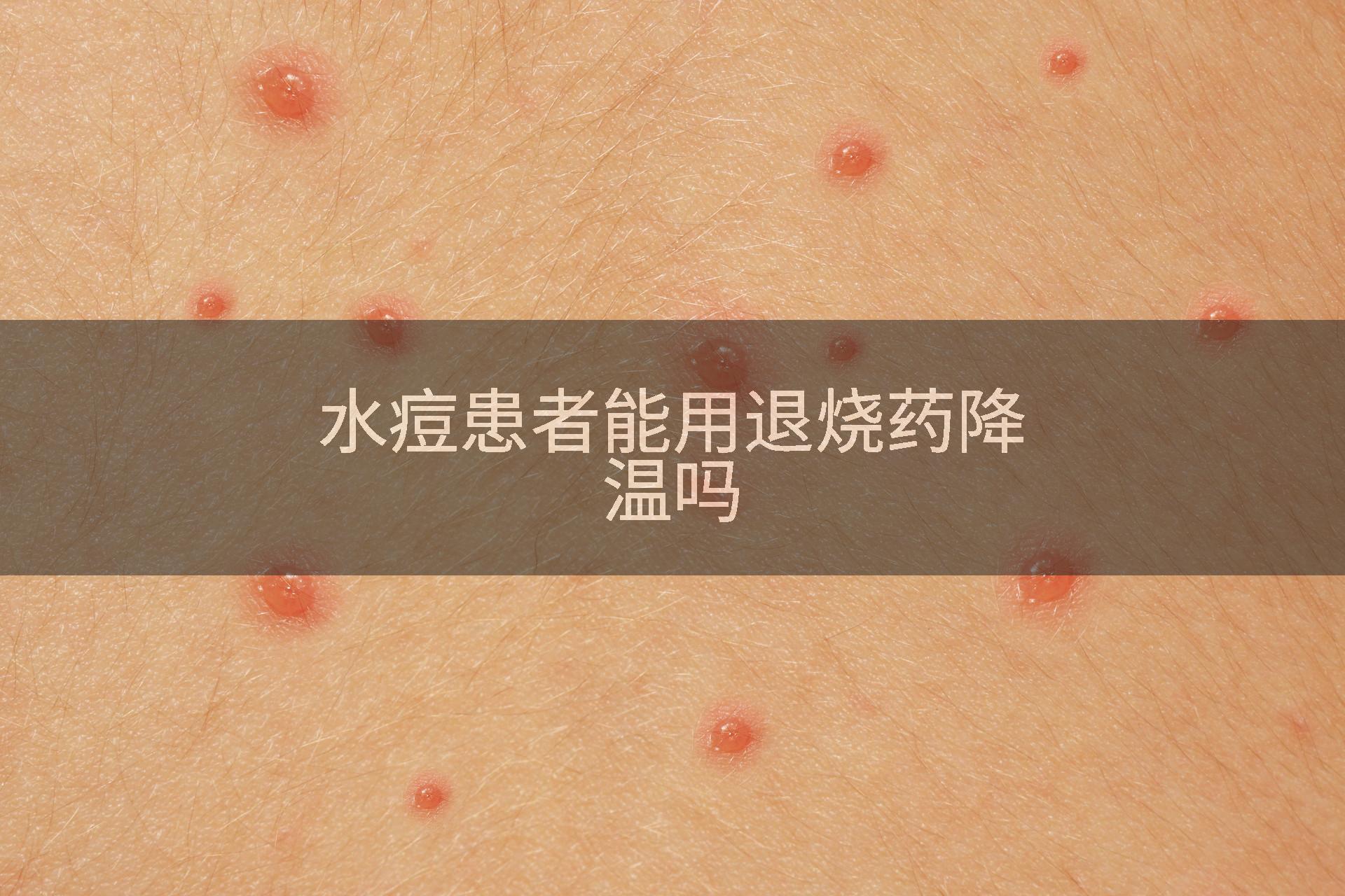 水痘患者能用退烧药降温吗