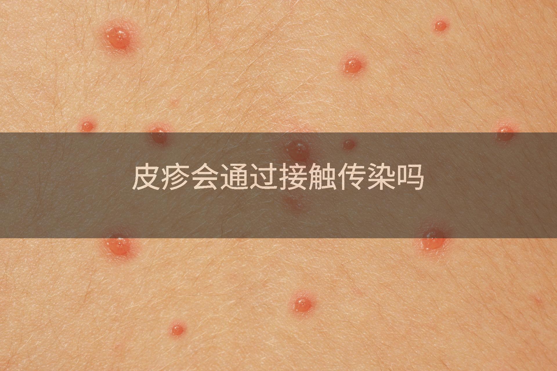 皮疹会通过接触传染吗